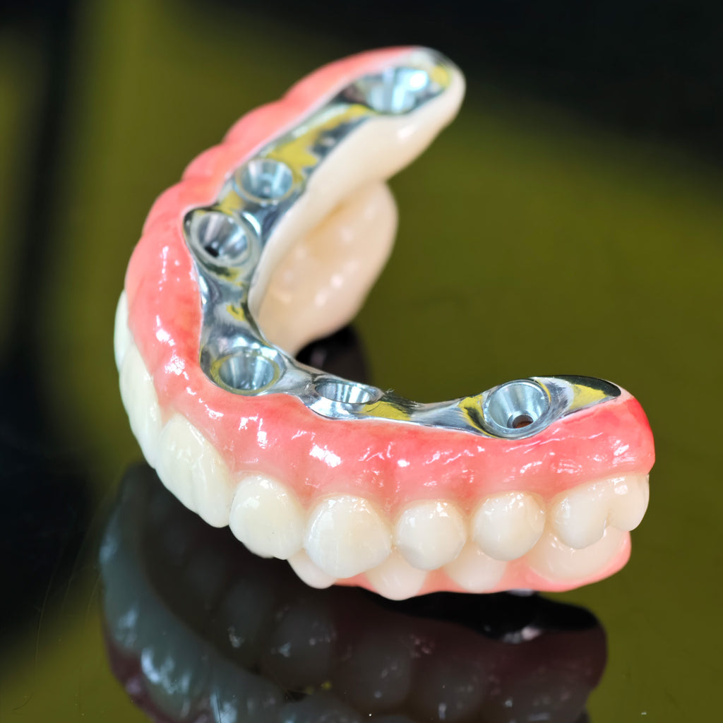 Ti-Bar Titanium Nitride Metal Frame With Zirconia Bridge For Full Arch Restoration