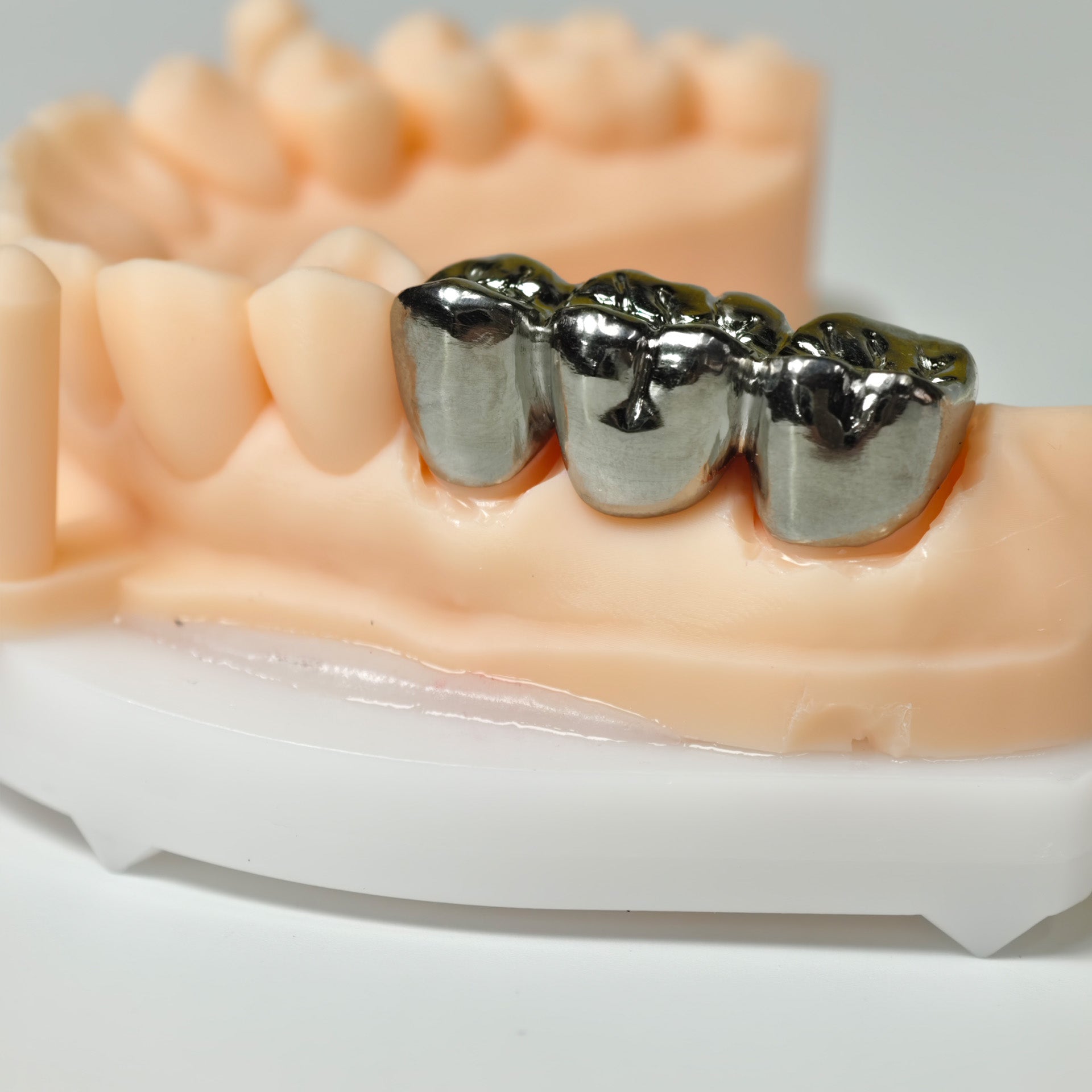 Titanium Crown With Cement Retained