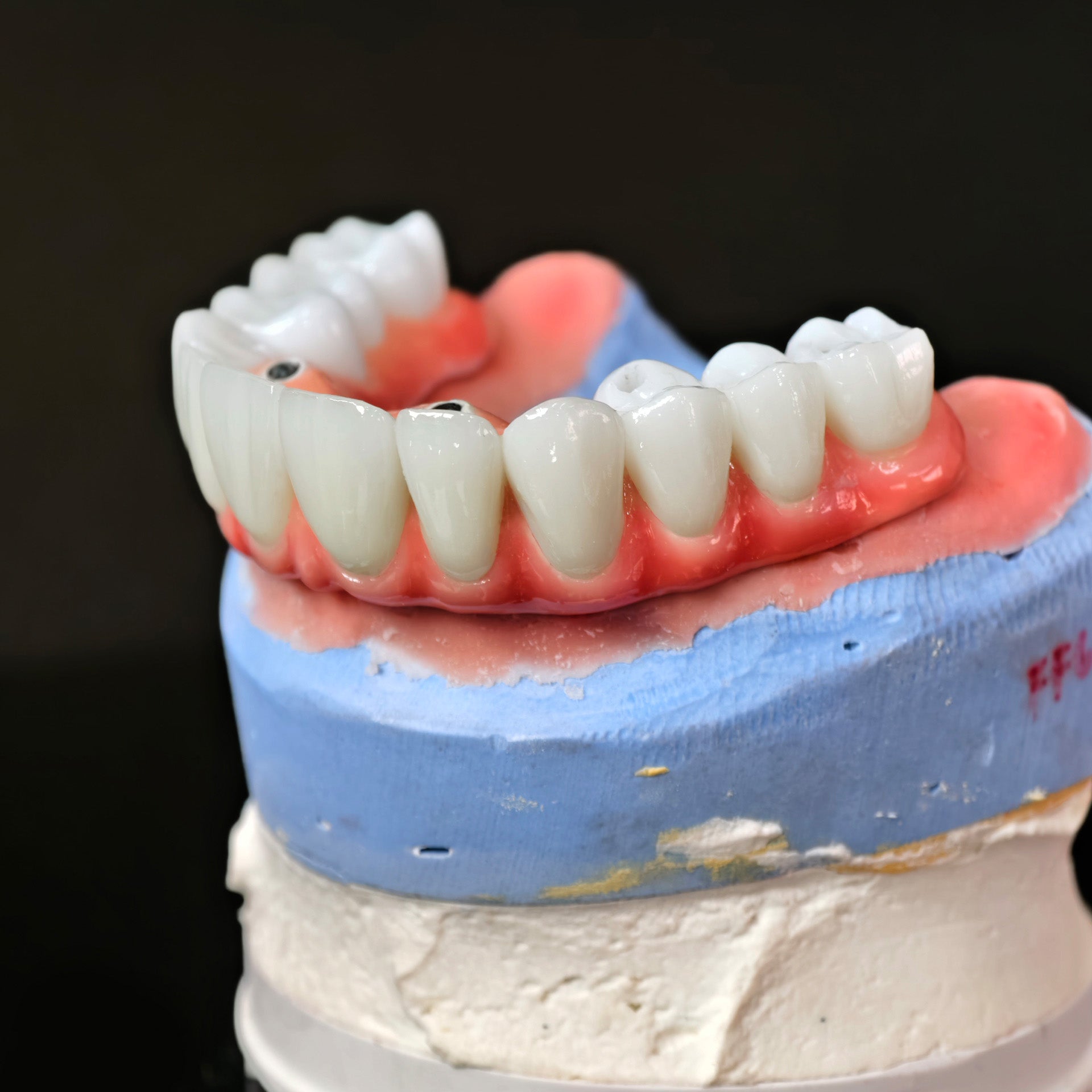 Traditional Malo Bridge With Alloy Framework Covering The Gingiva