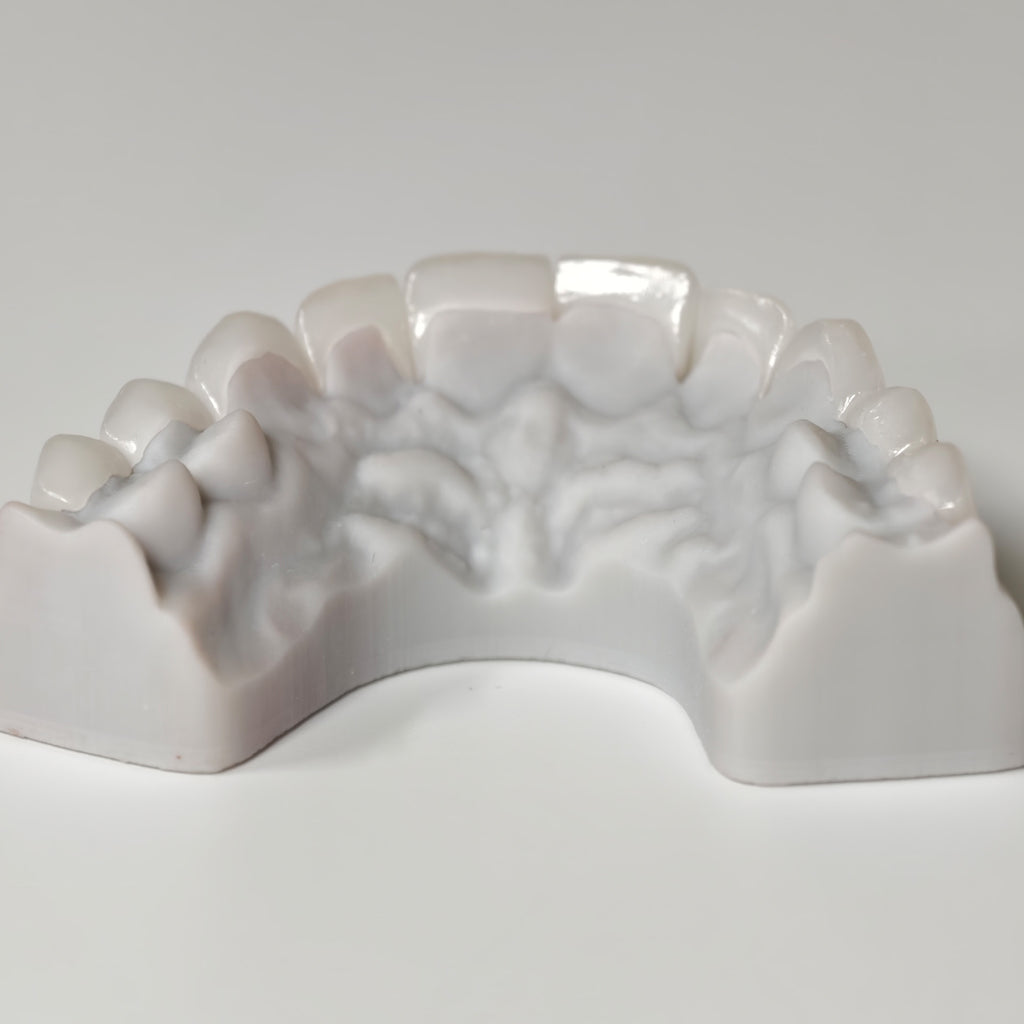 Ultra-Thin Emax Veneer. High Transparency/Translucent, Natural Shade
