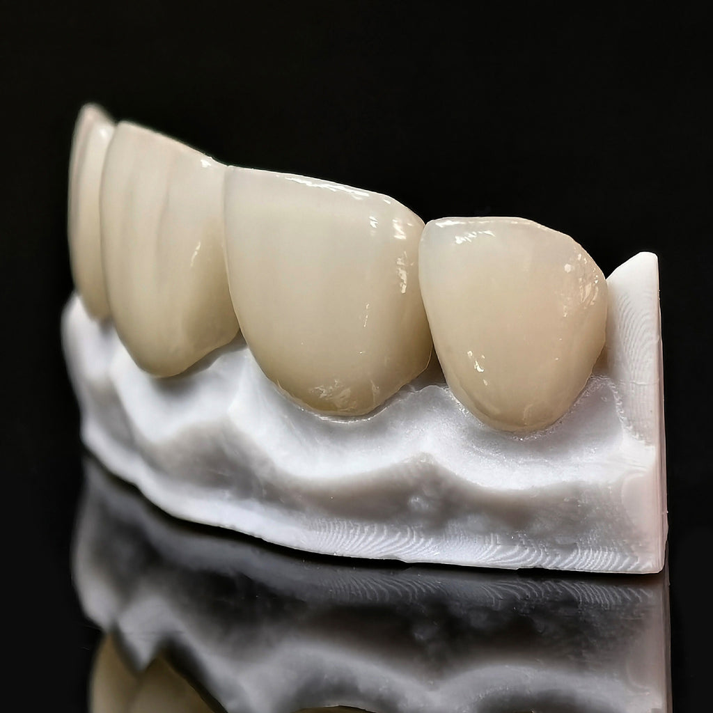 Ultra-Thin Emax Veneer. High Transparency/Translucent, Natural Shade