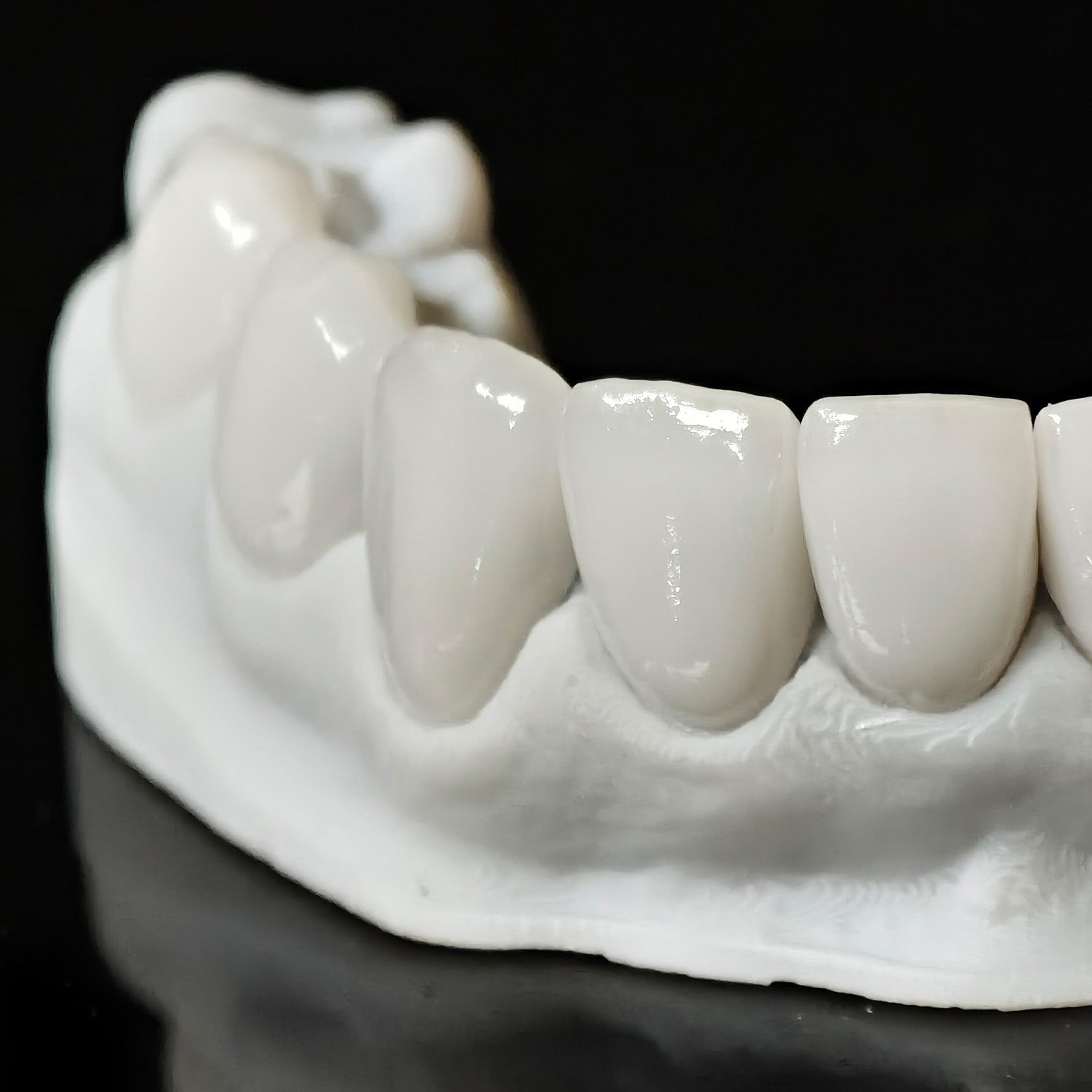 Ultra-Thin Emax Veneer. High Transparency/Translucent, Natural Shade