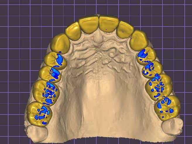 Upper And Lower Smile Design