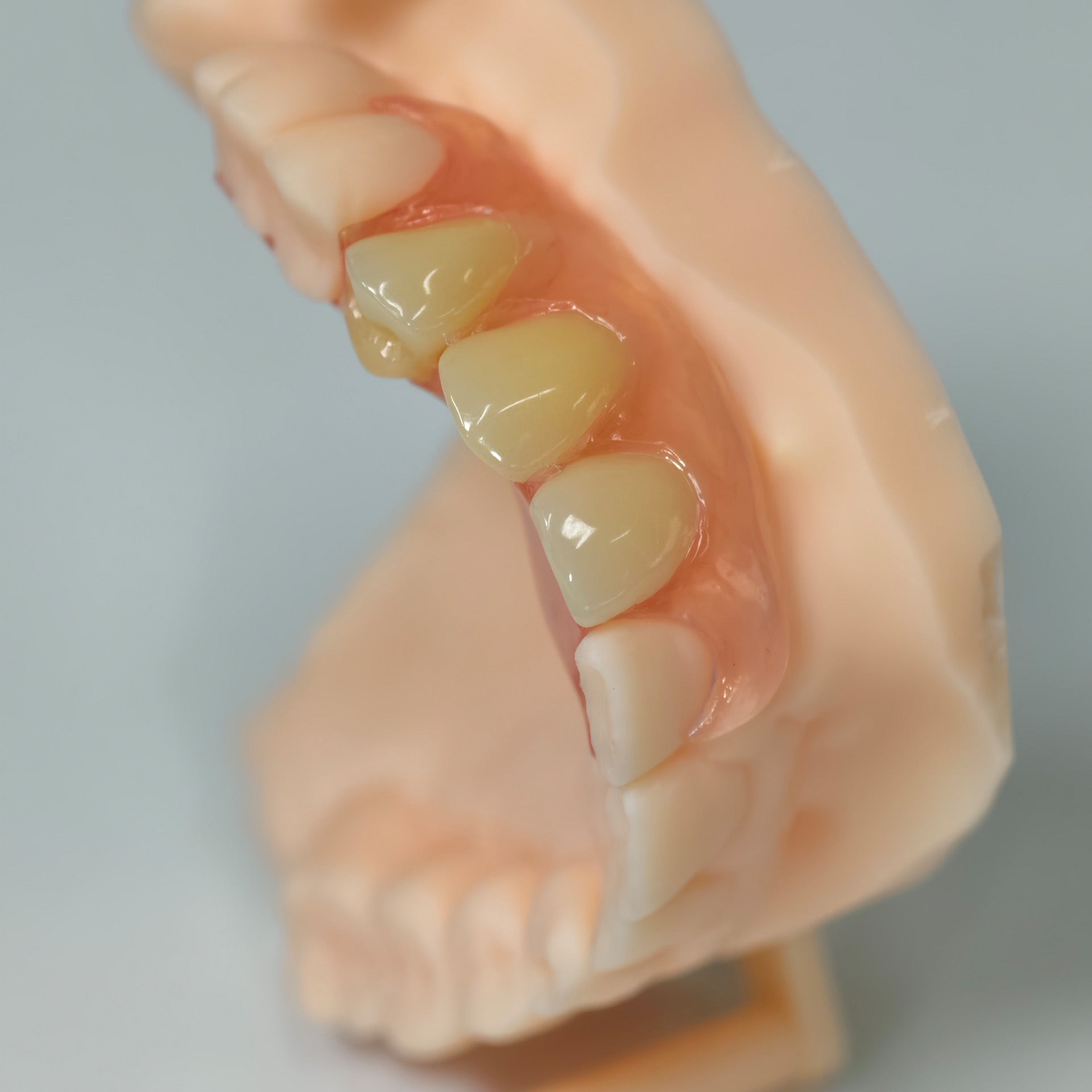 Valplast Denture Beautiful And Elastic Flexible Partial Natural Appearance
