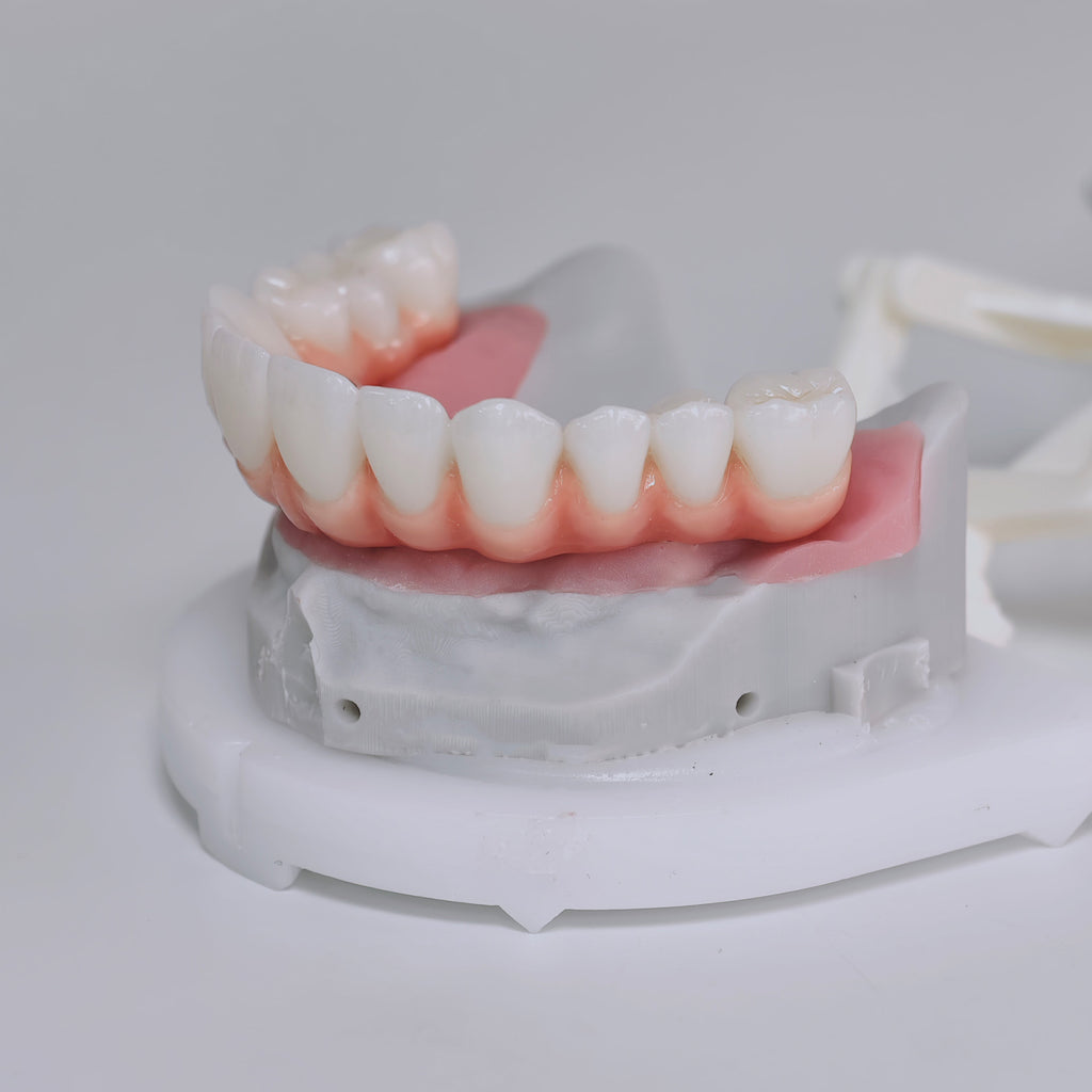 Zirconia-Enamel Hybrid Malo Bridge Aesthetic