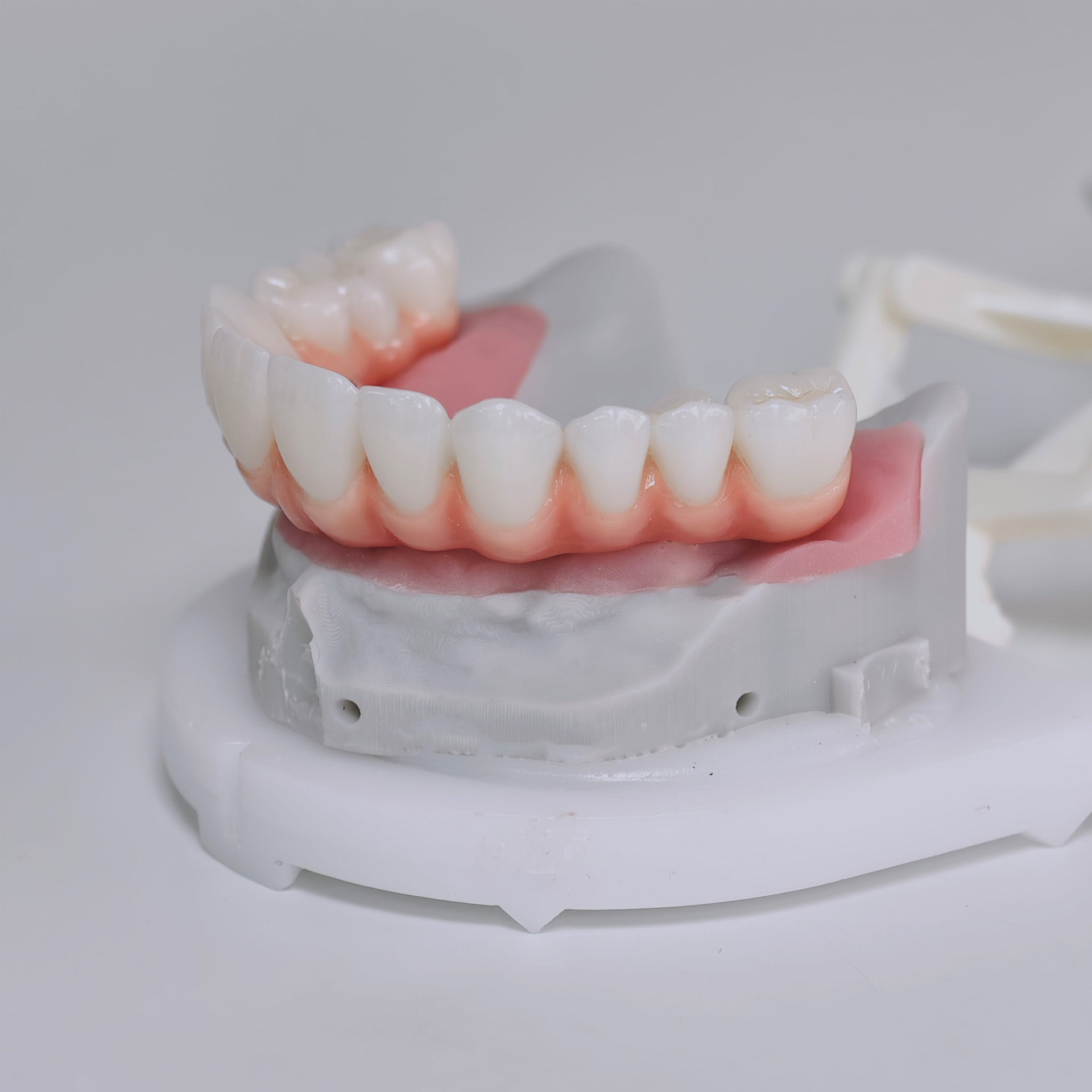 Zirconia-Enamel Hybrid Malo Bridge Aesthetic