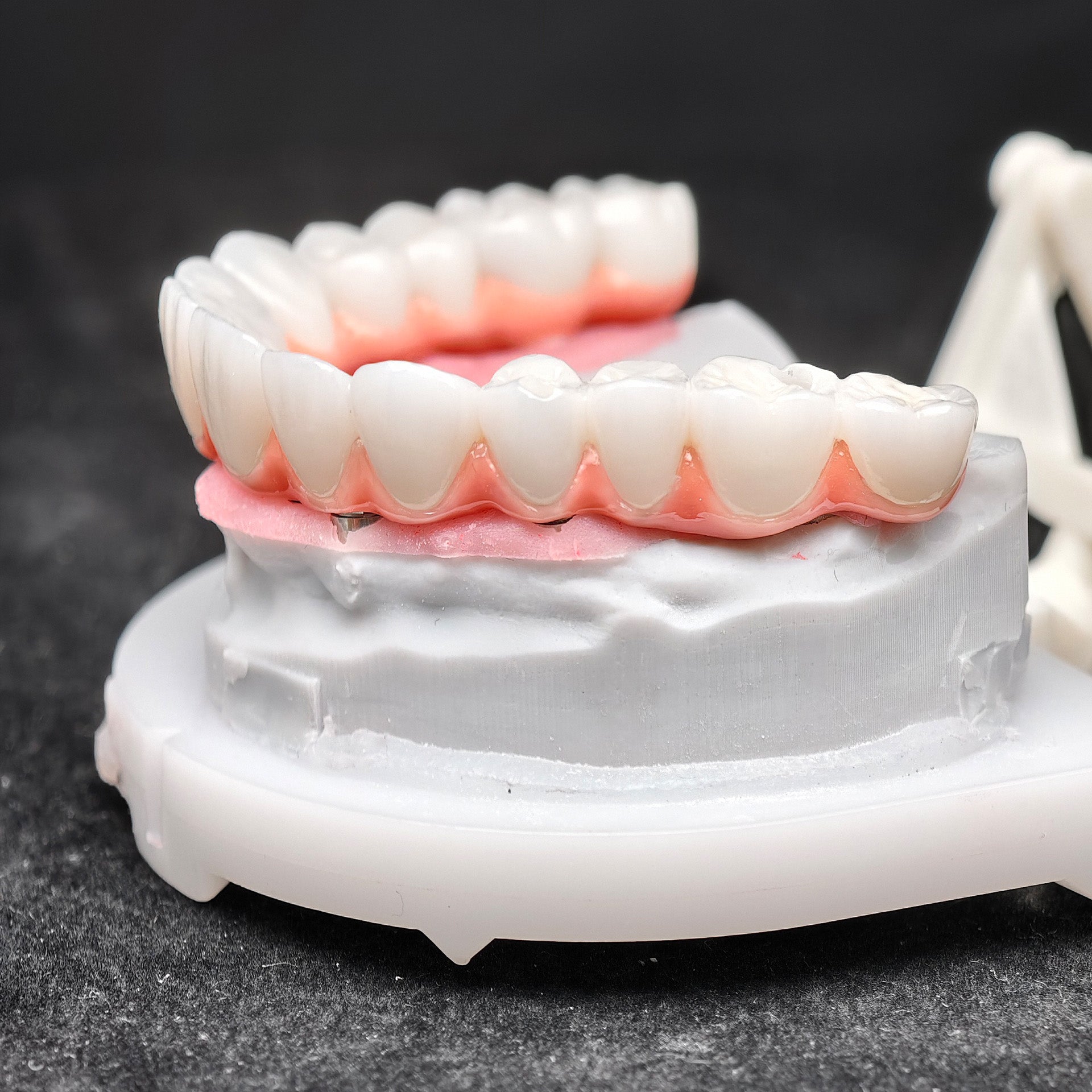 Zirconia-Enamel Hybrid Malo Bridge