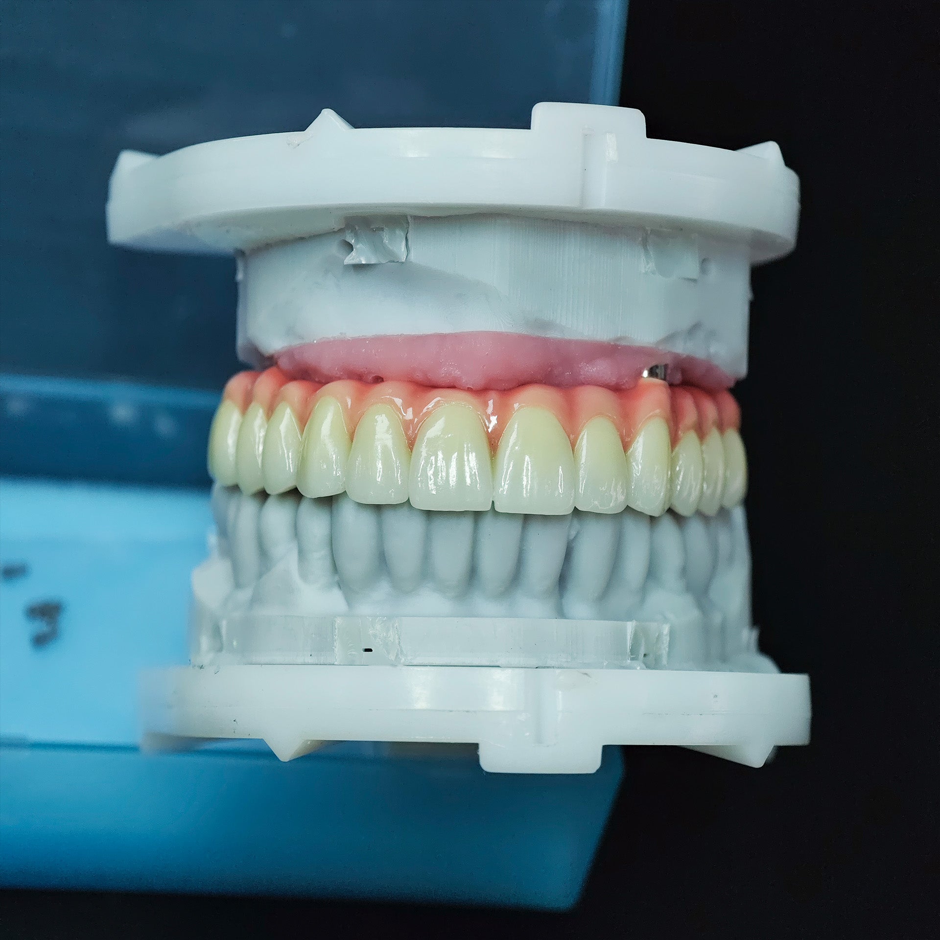 Zirconia-Enamel Hybrid Malo Bridge
