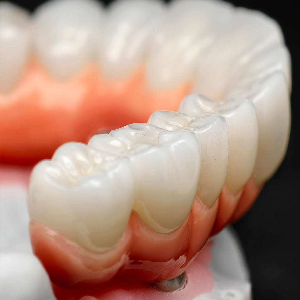 Zirconia-Enamel Hybrid Malo Bridge