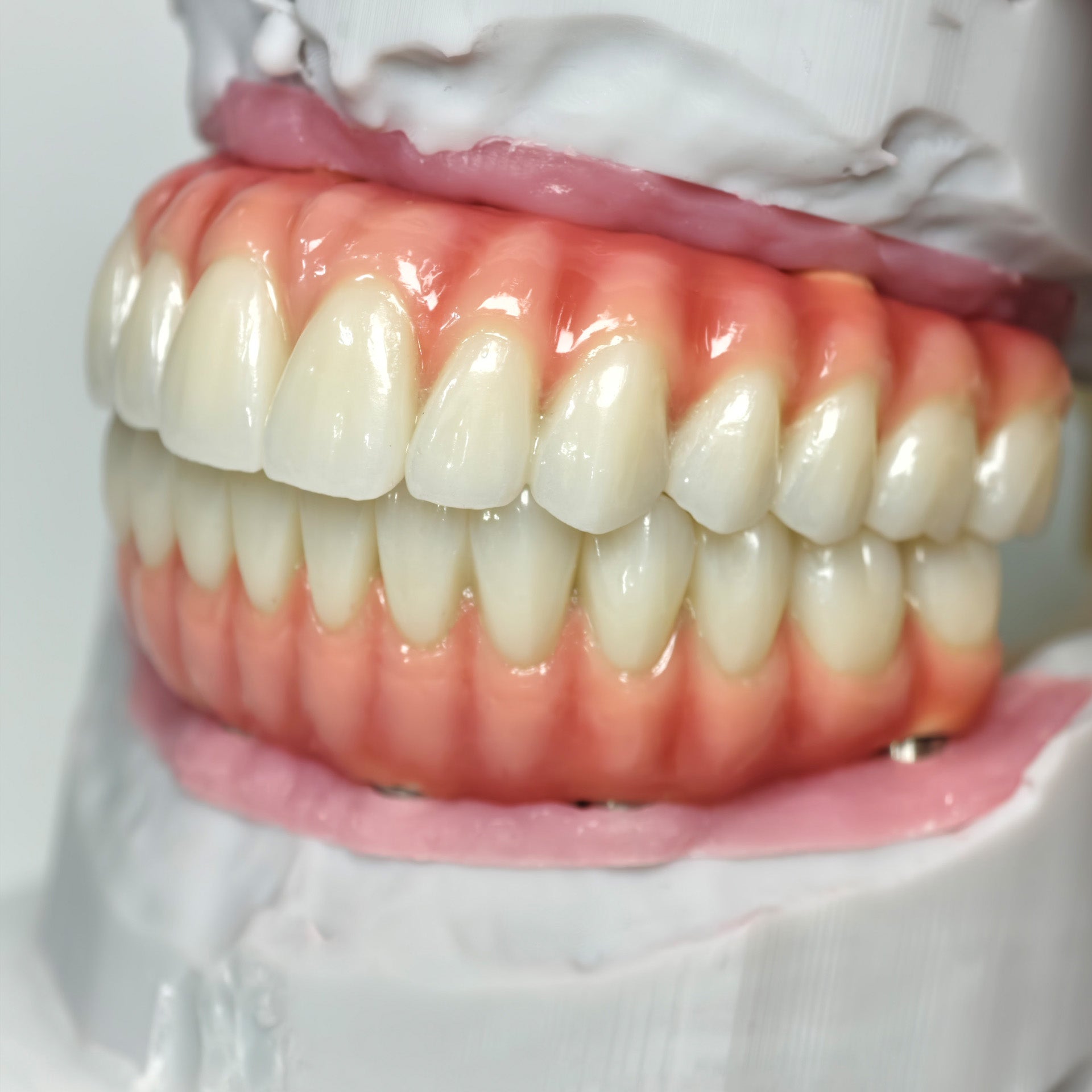 Zirconia-Enamel Hybrid Malo Bridge