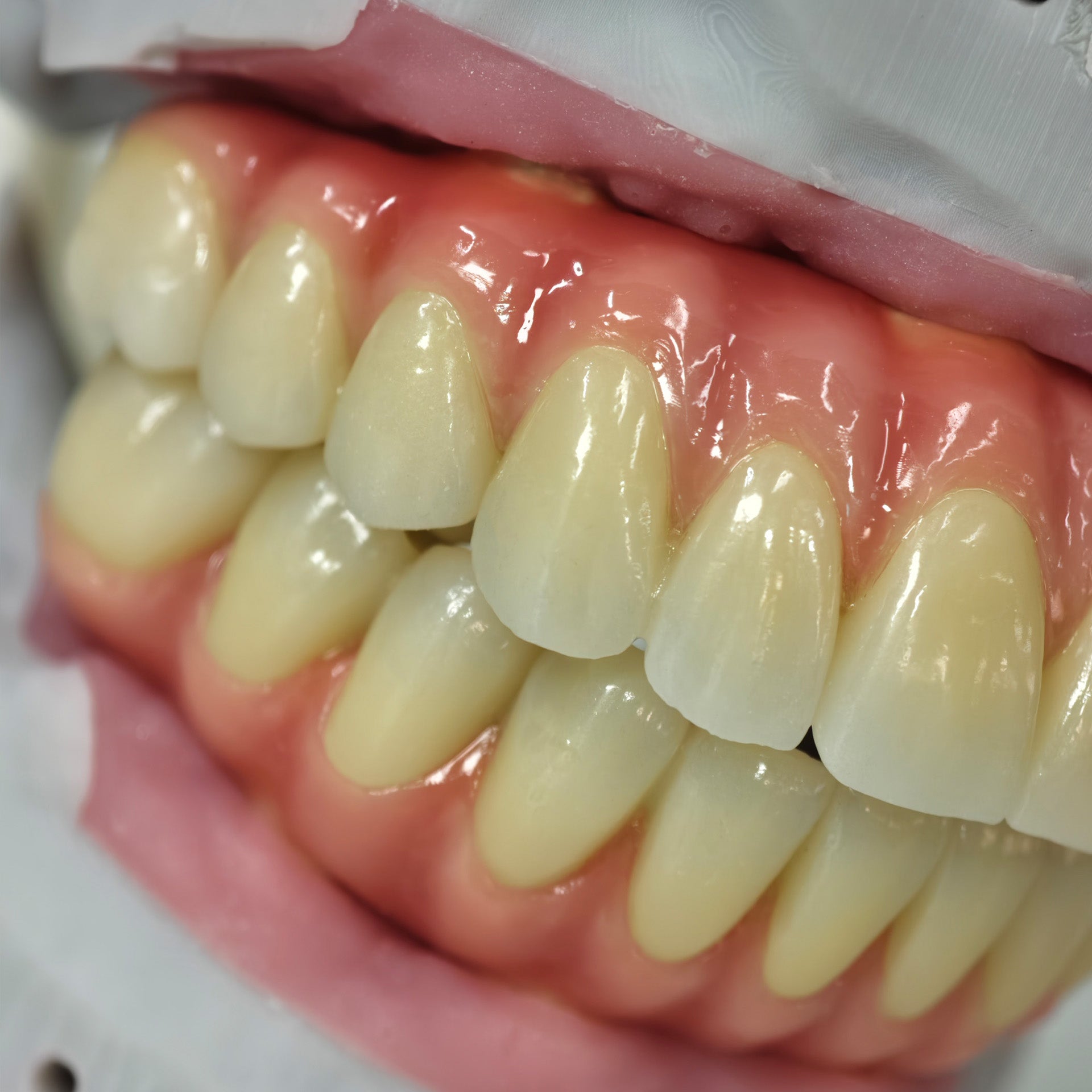 Zirconia-Enamel Hybrid Malo Bridge