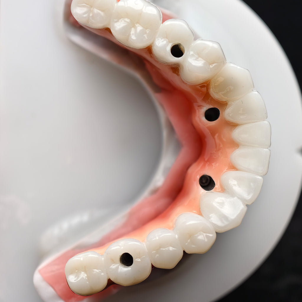 Zirconia-Enamel Hybrid Malo Bridge