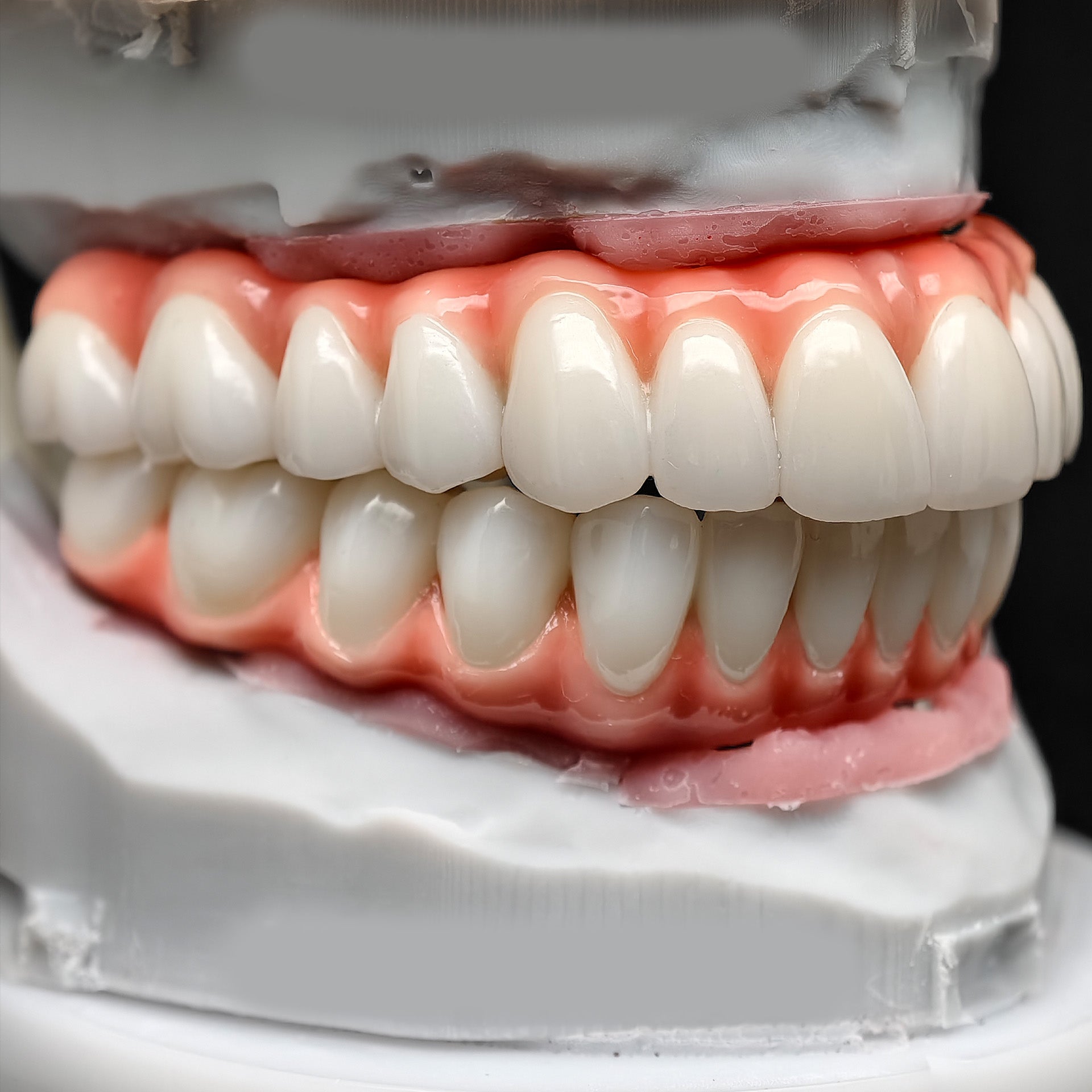 Zirconia-Enamel Hybrid Malo Bridge