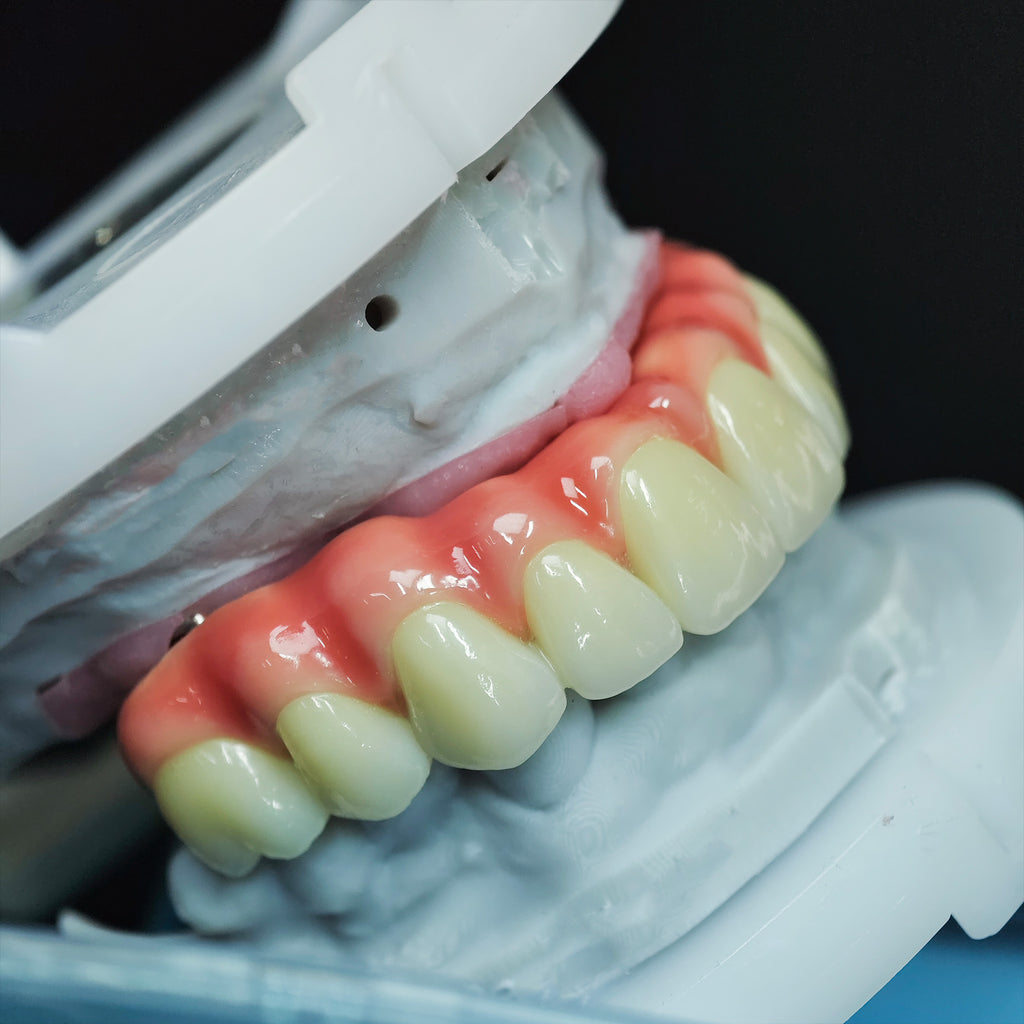 Zirconia-Enamel Hybrid Malo Bridge