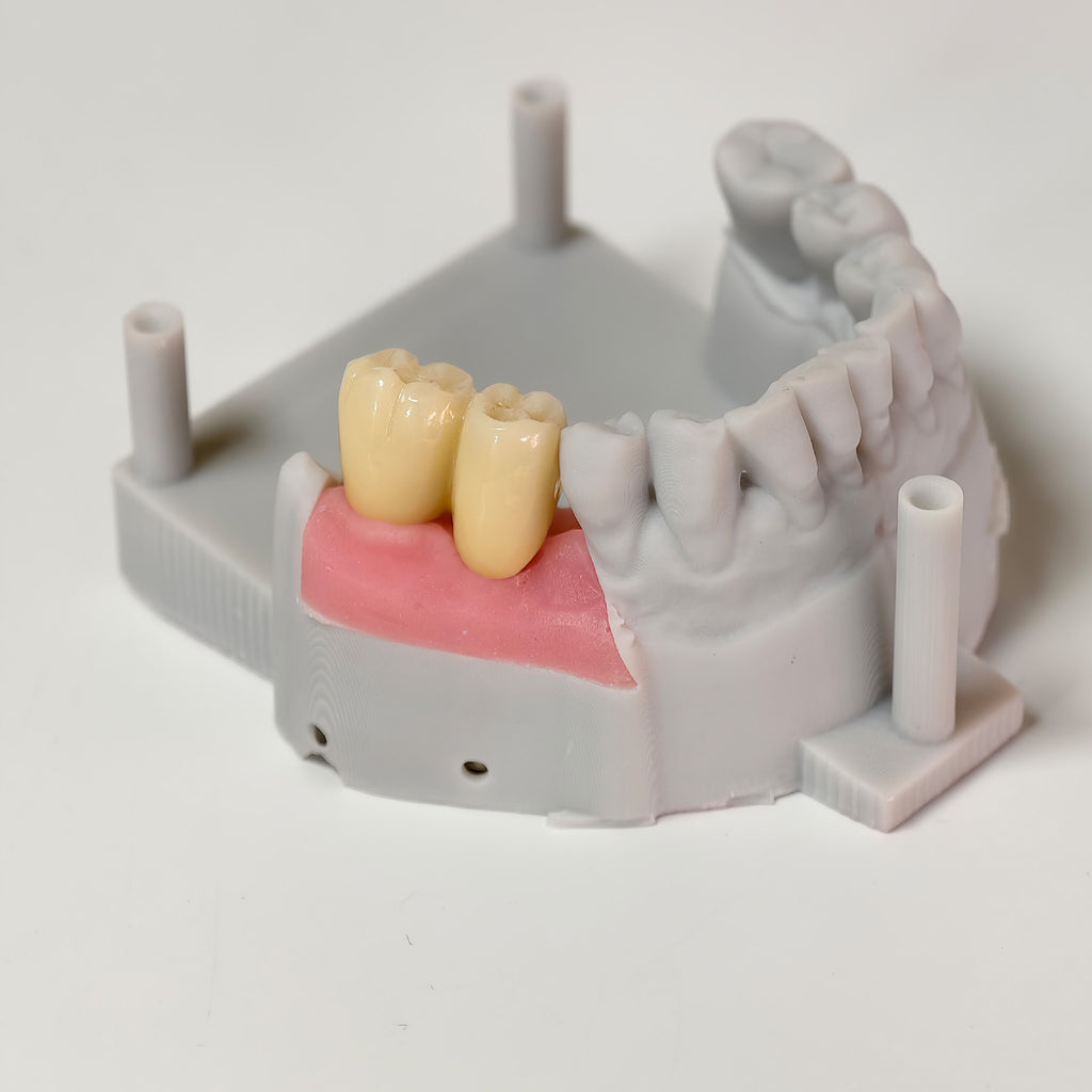 Zirconia Bridge With Screw Retained