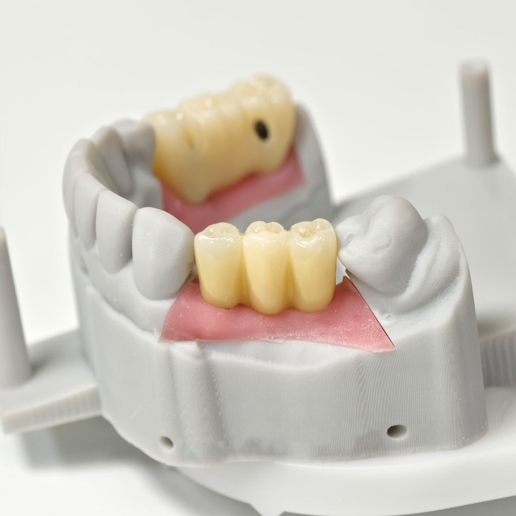 Zirconia Bridges With Screw Retained