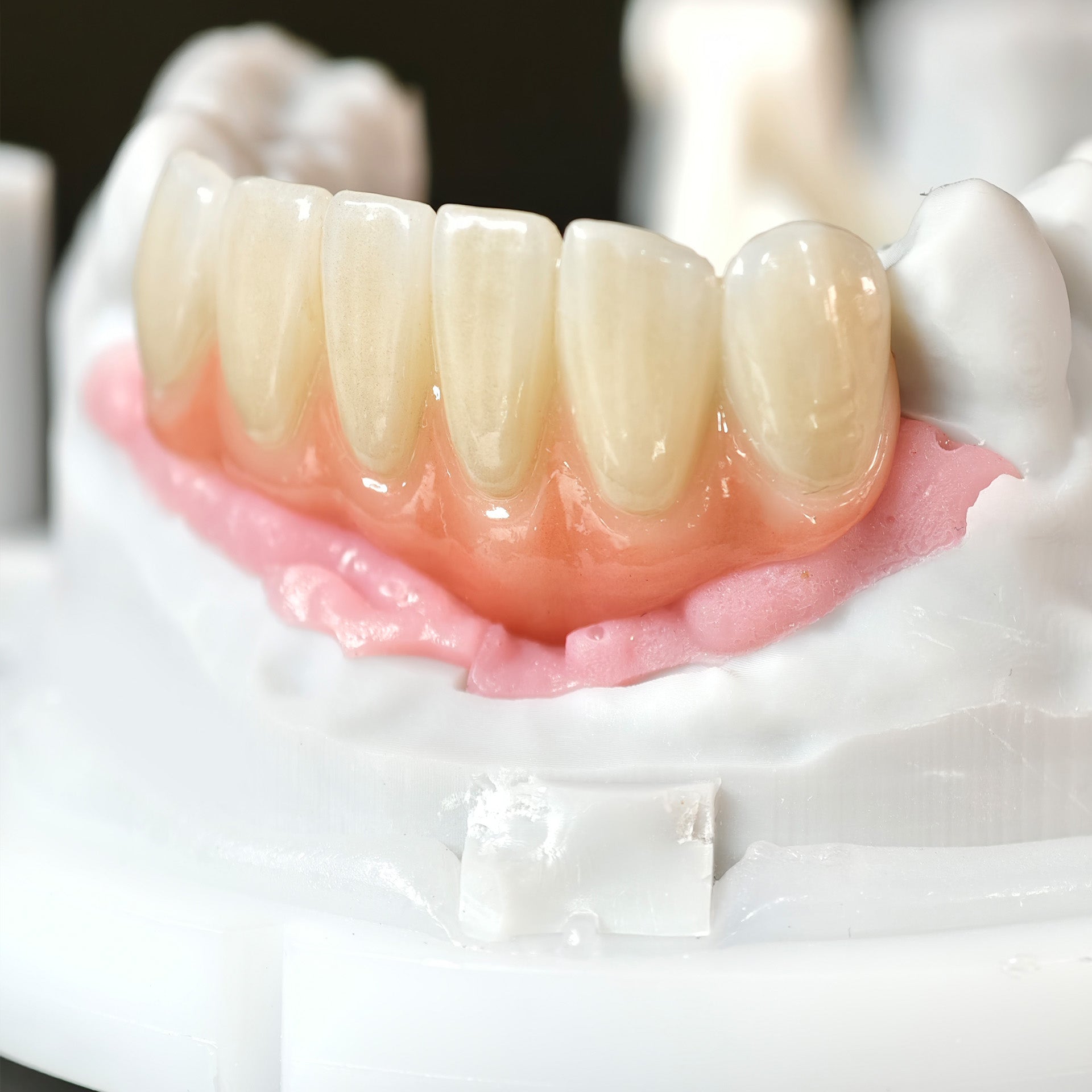 Zirconia Bridge With Ti-Base Screw Retained