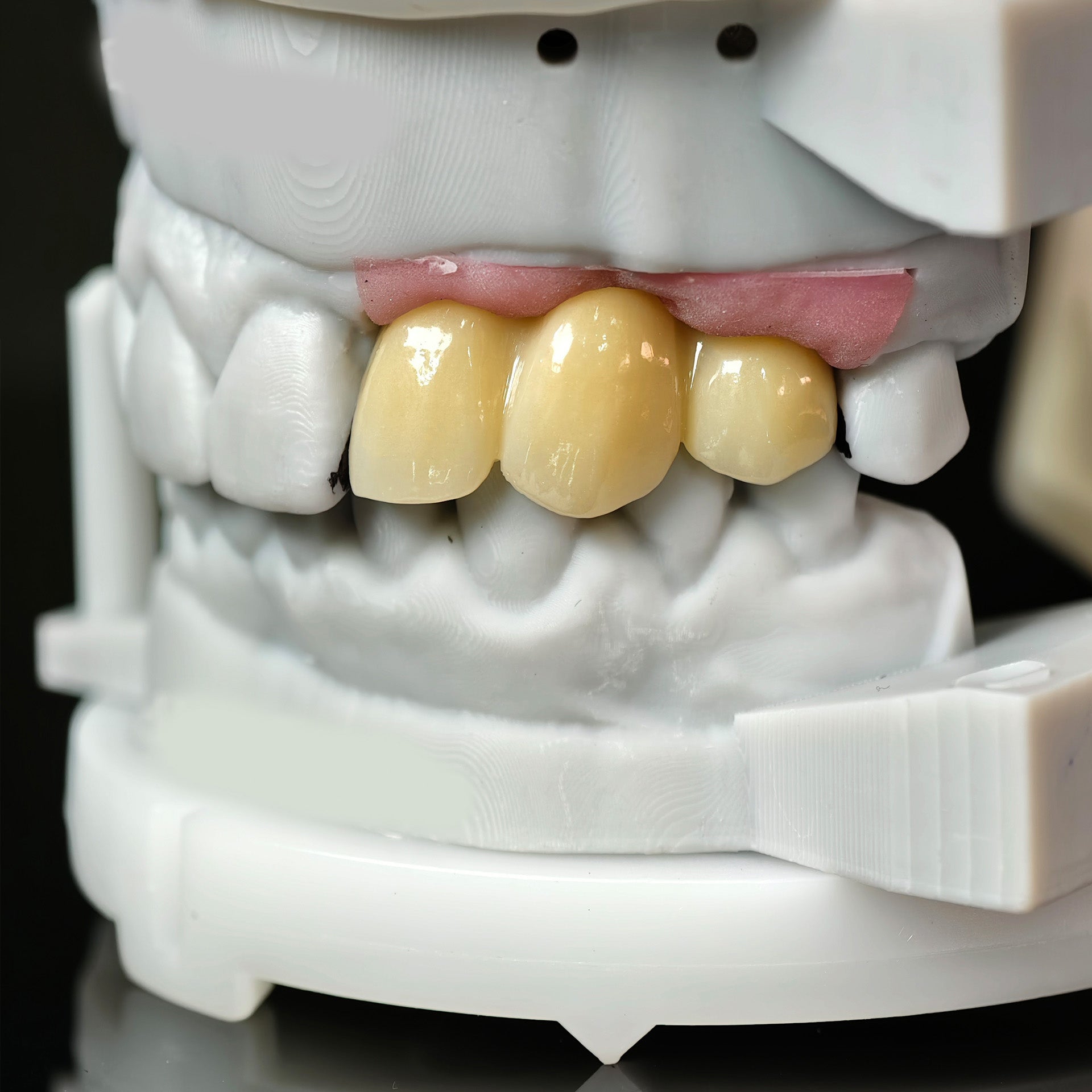 Zirconia Bridge With Ti-Base Screw Retained