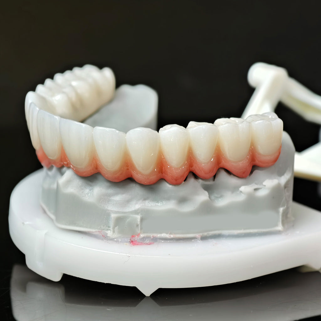 Zirconia Bridge With Cement Retained And Titanium Bar