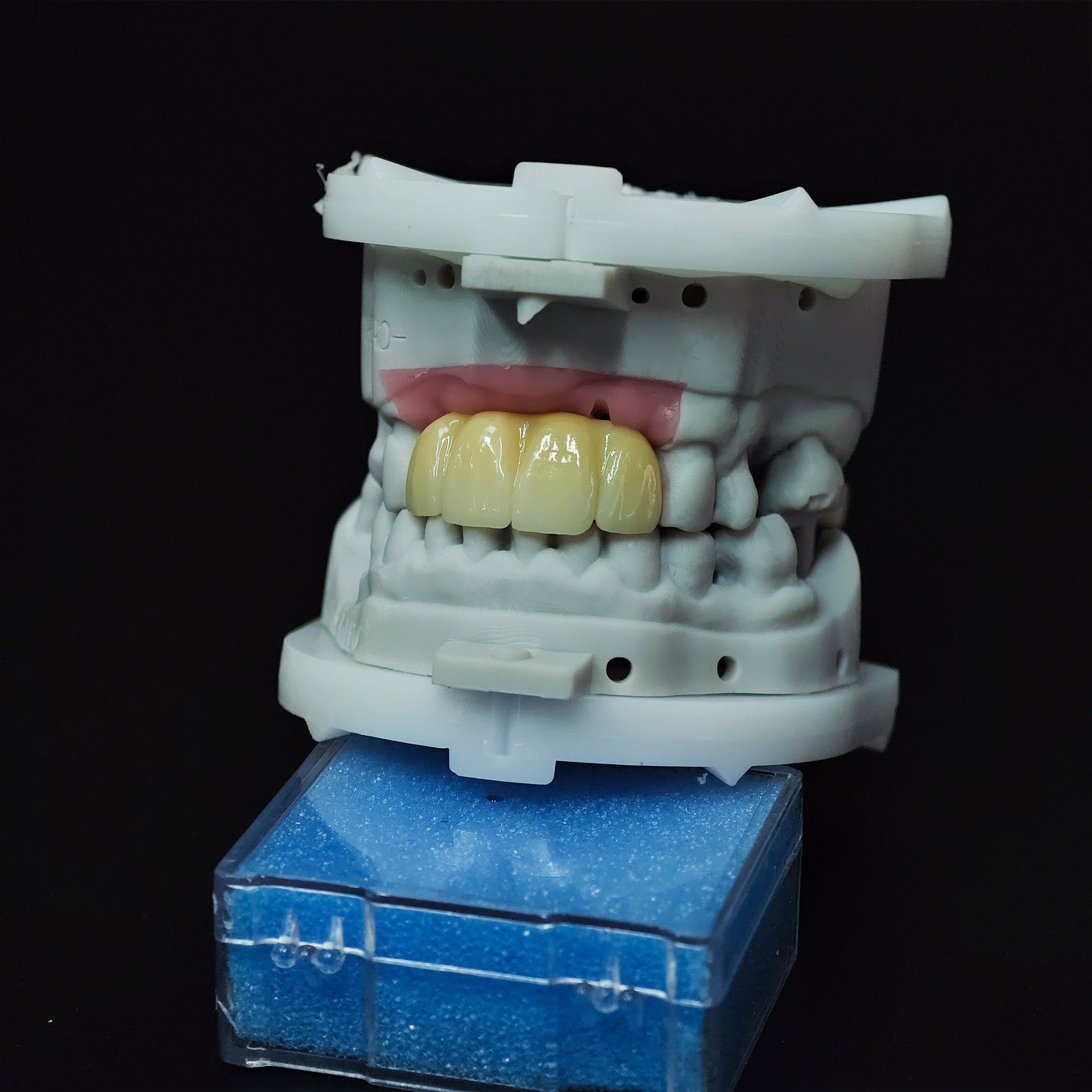 Zirconia Bridge With Screw Retained