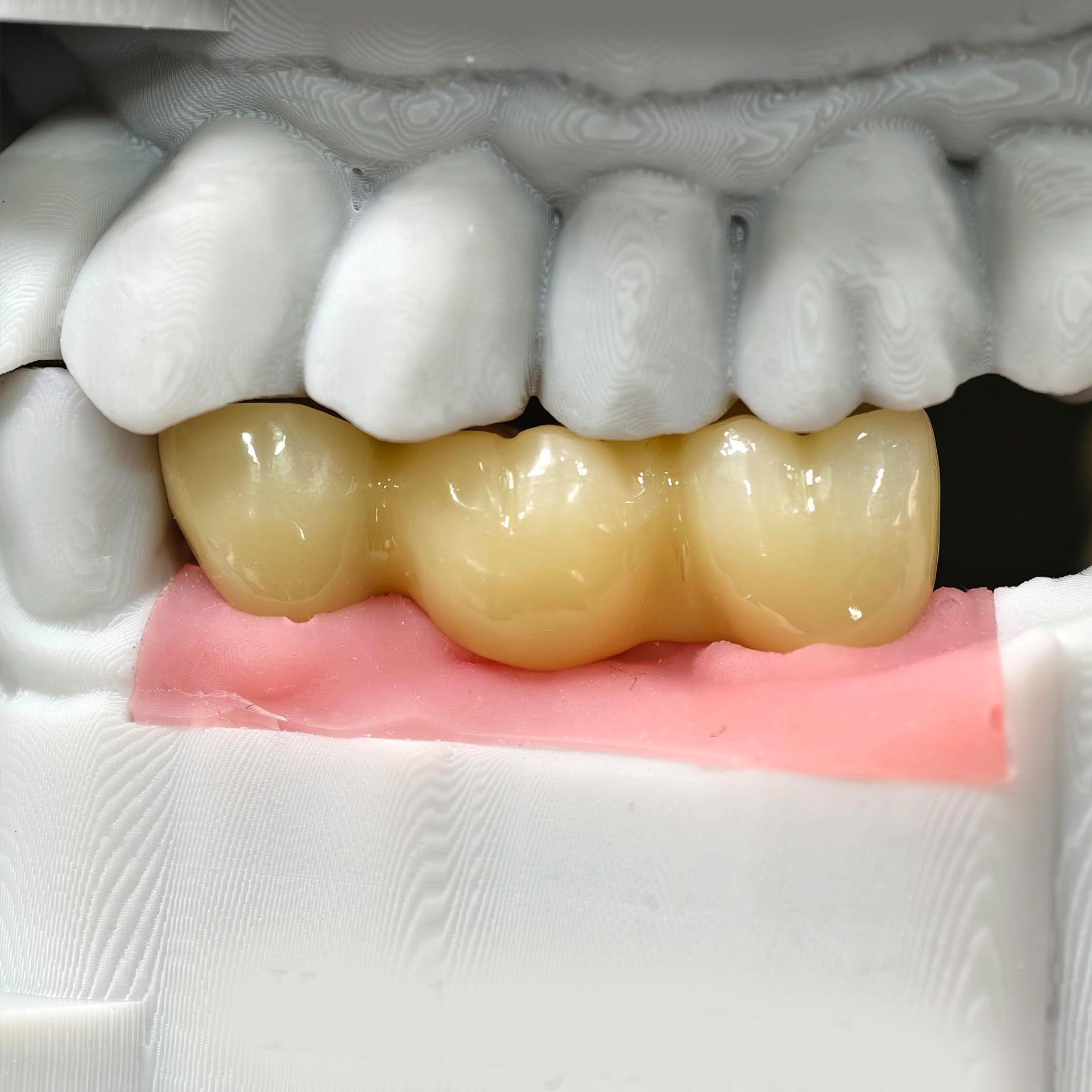 Zirconia Bridge With Screw Retained