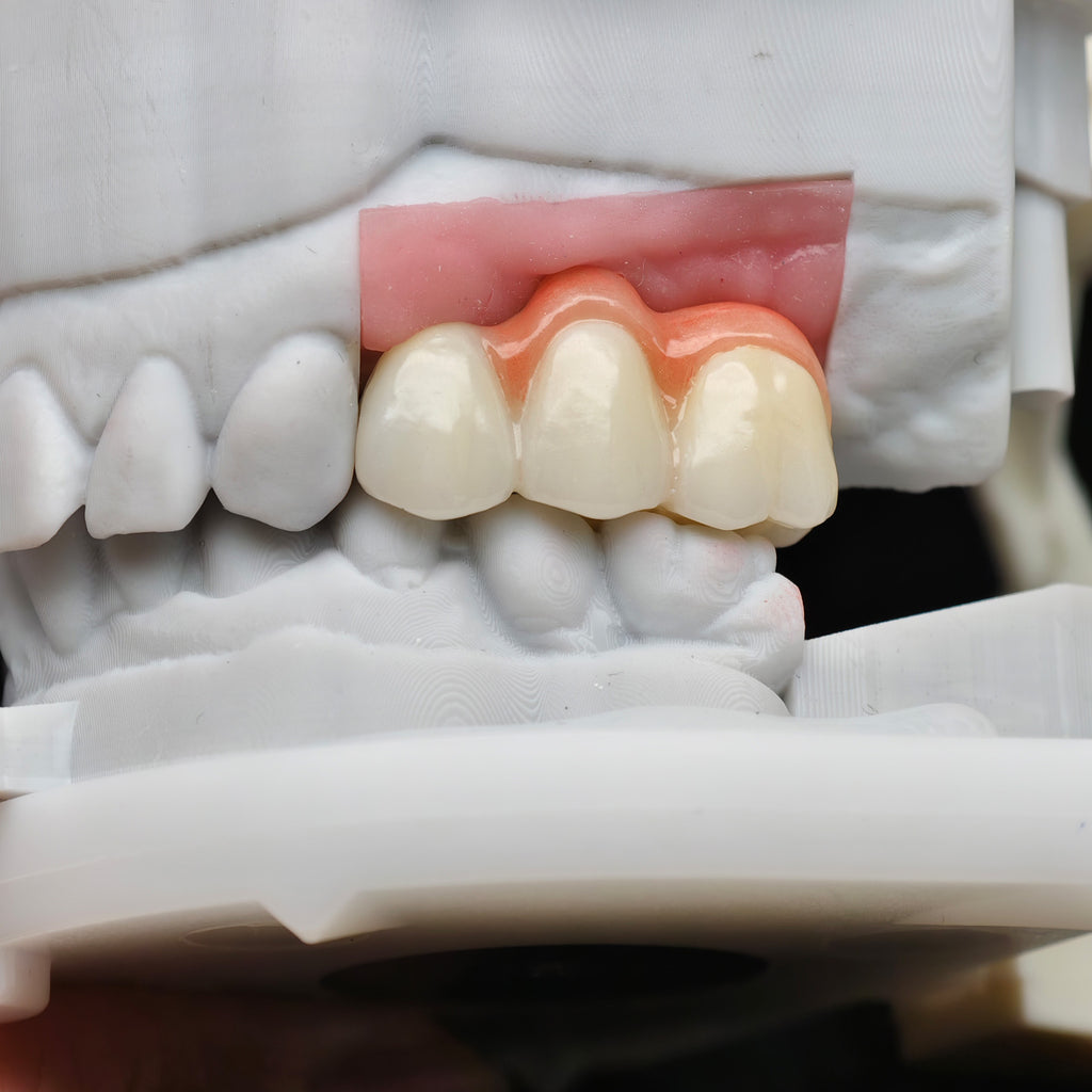 Zirconia Bridge With Screw Retained