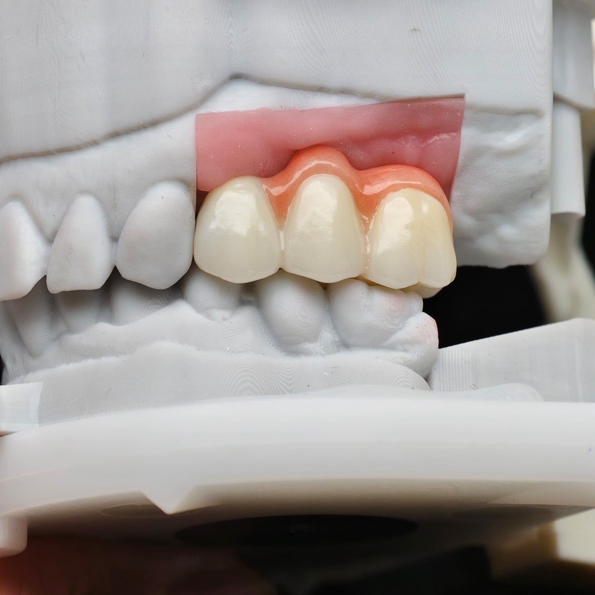 Zirconia Bridge With Screw Retained