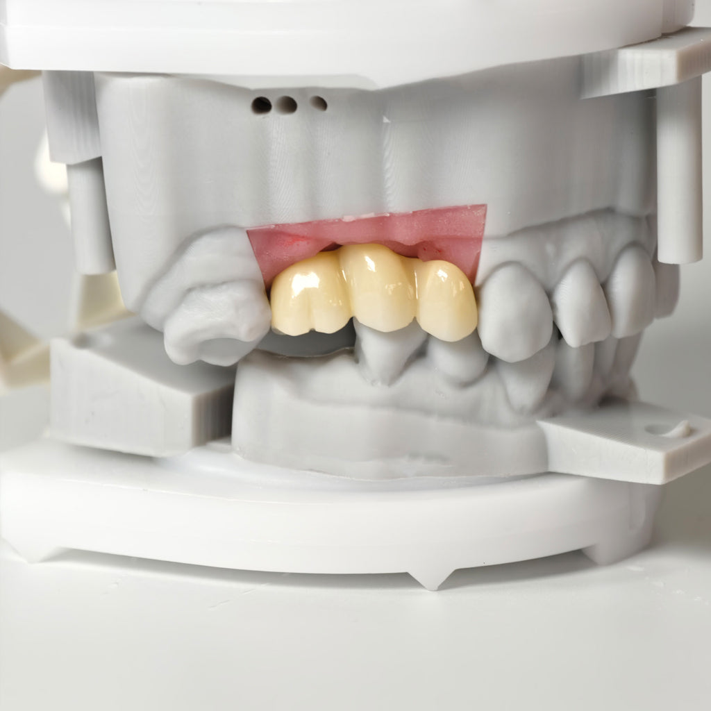 Zirconia Bridgewith Screw Retained