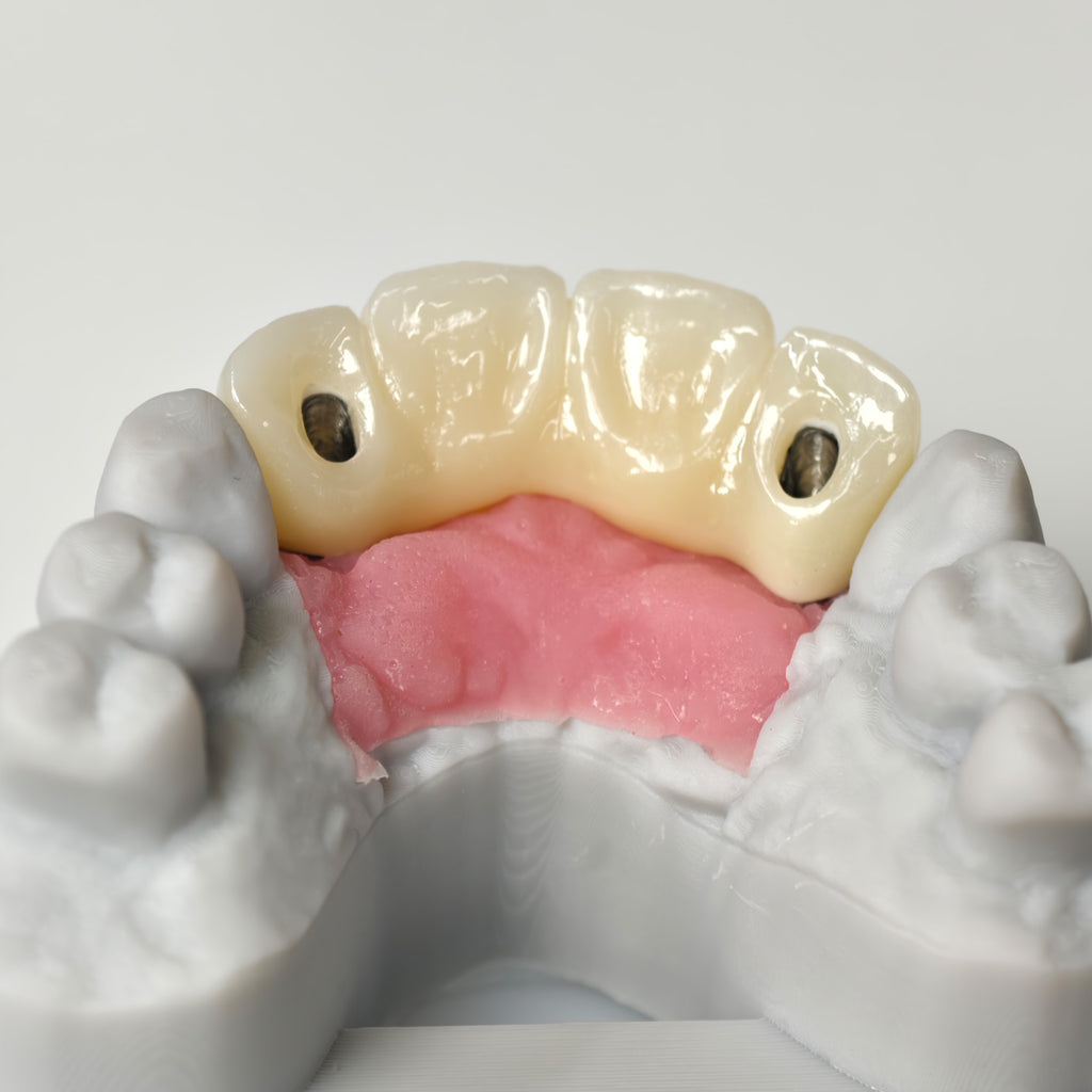 Zirconia Bridge With Screw Retained
