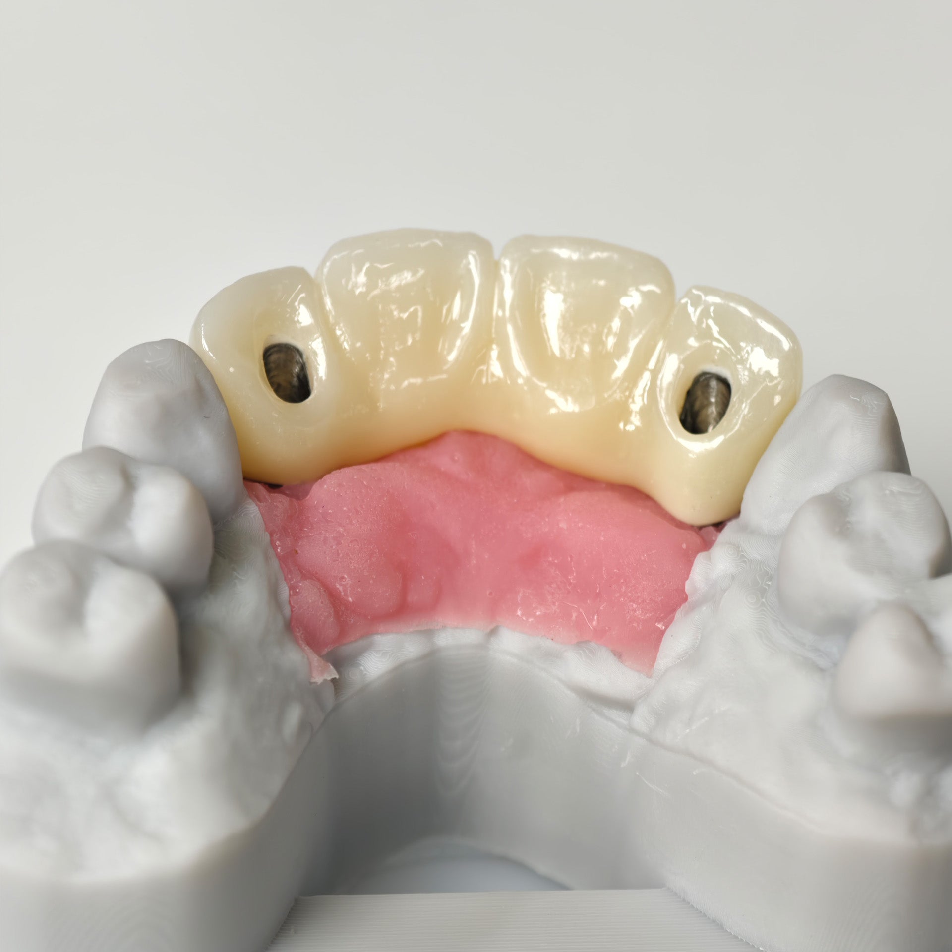 Zirconia Bridge With Screw Retained