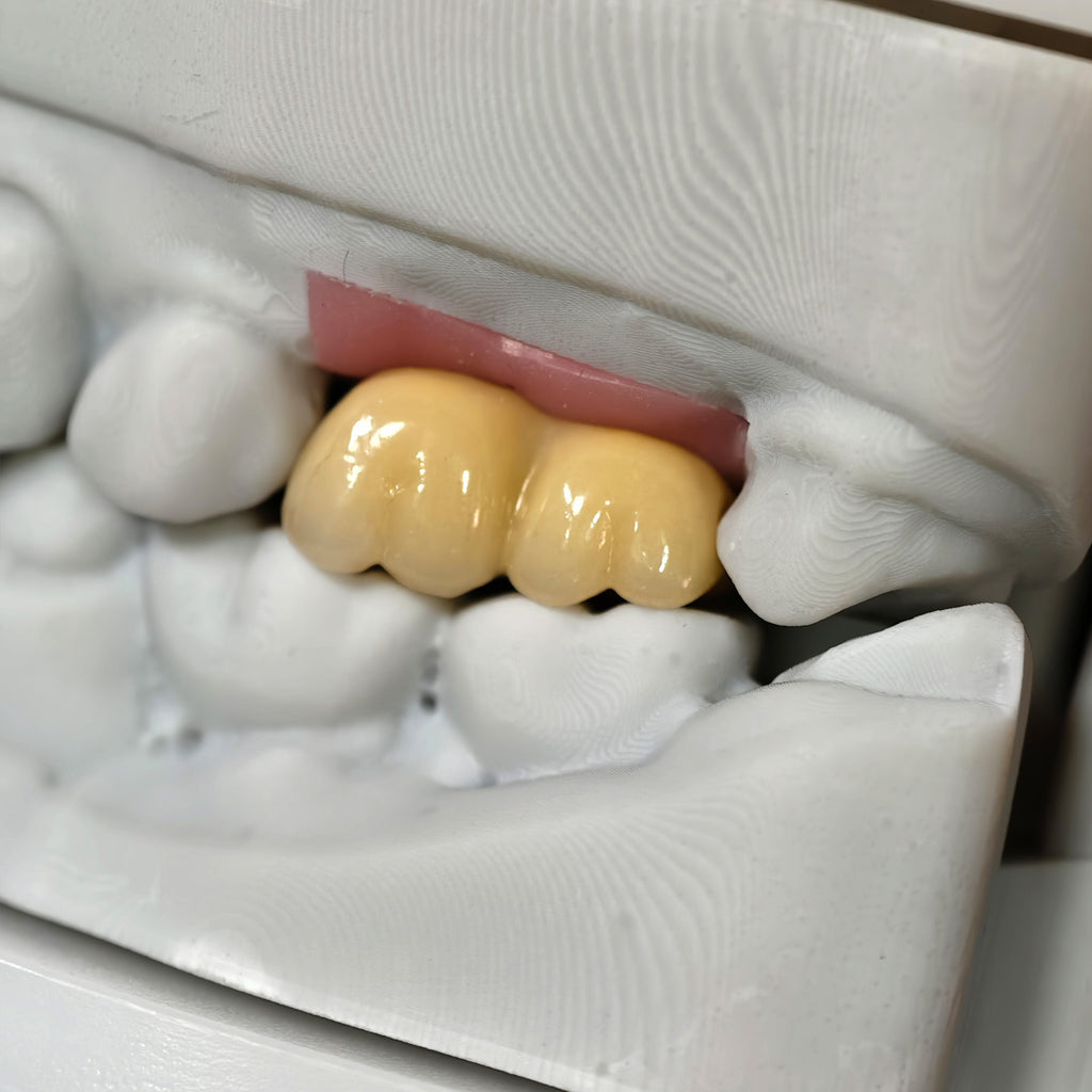 Zirconia Bridge With Screw Retained