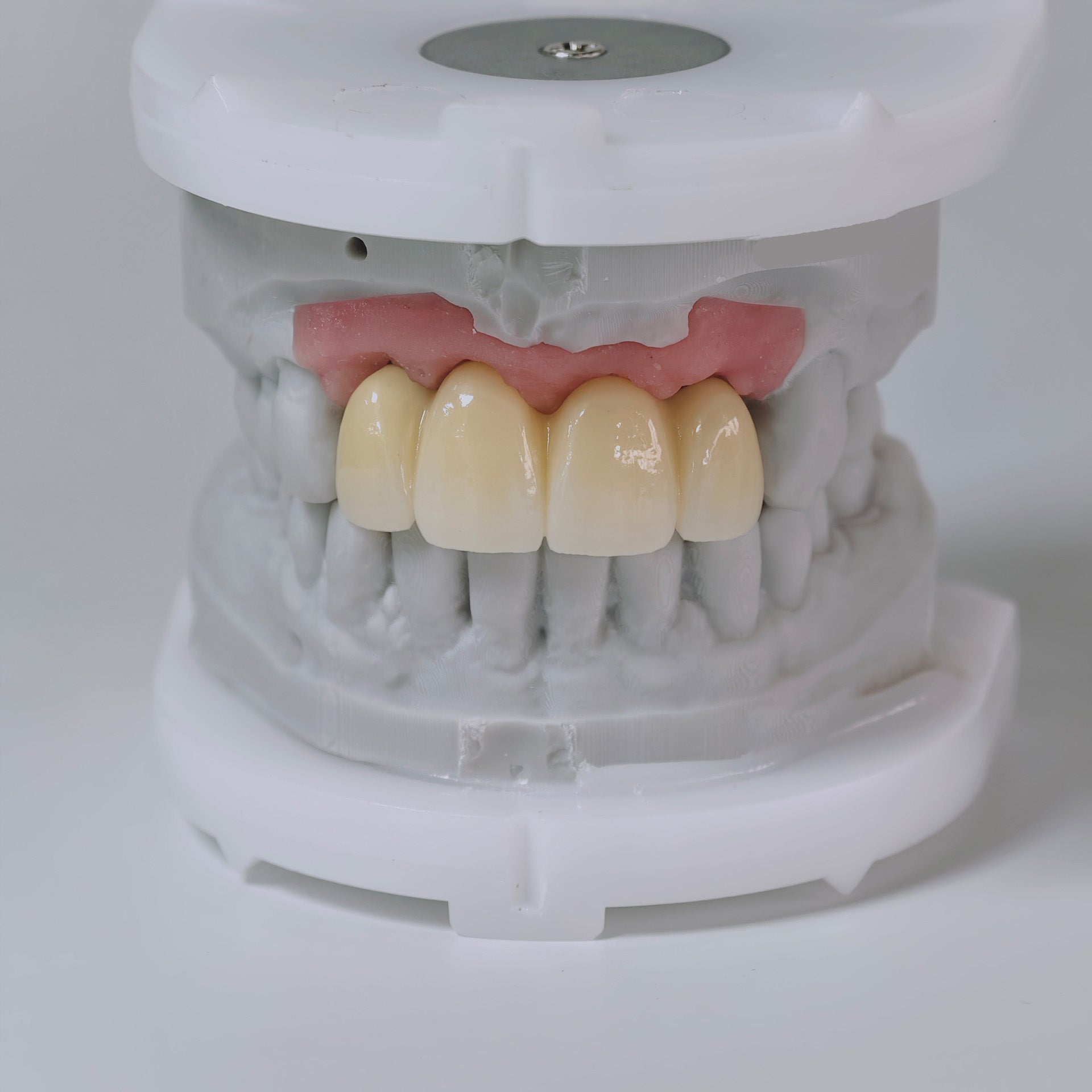 Zirconia Bridge With Screw Retained