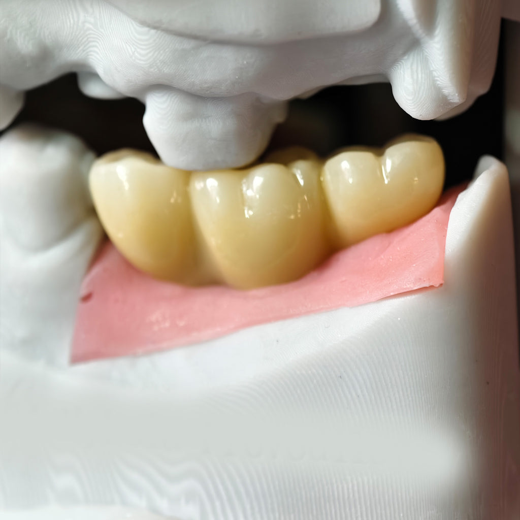Zirconia Bridge With Screw Retained Gold Plating
