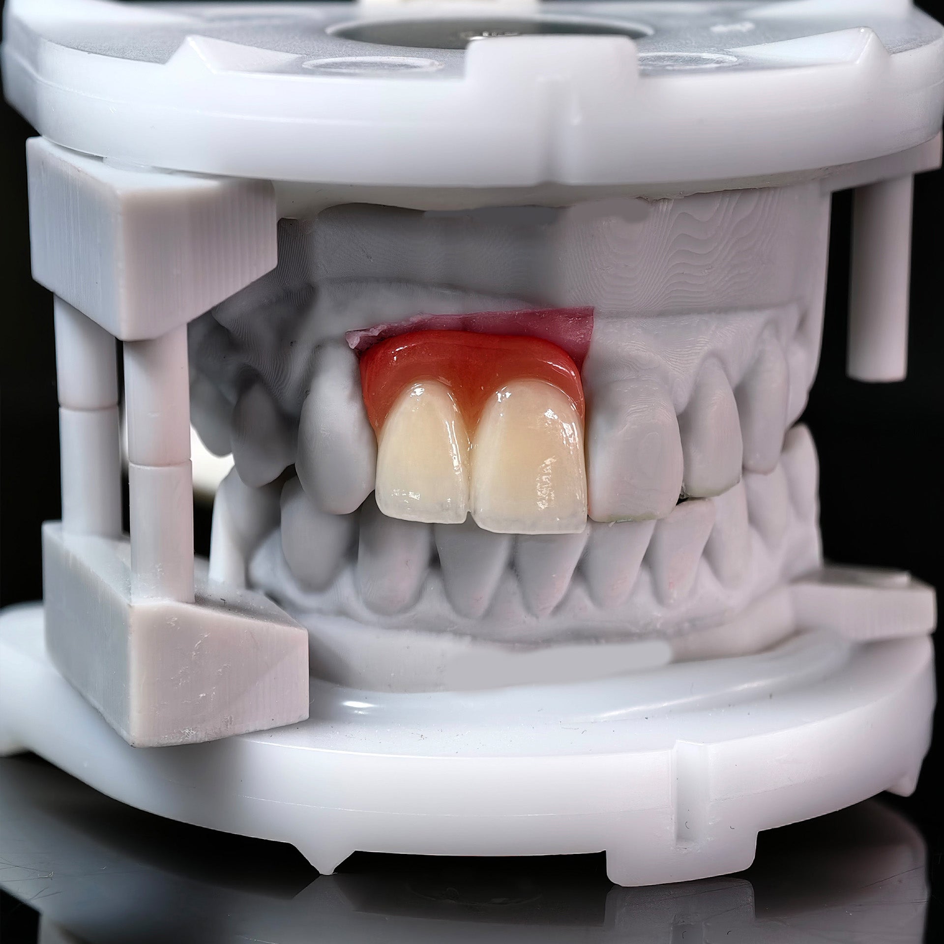 Zirconia Bridge With Ti-Base Bautment