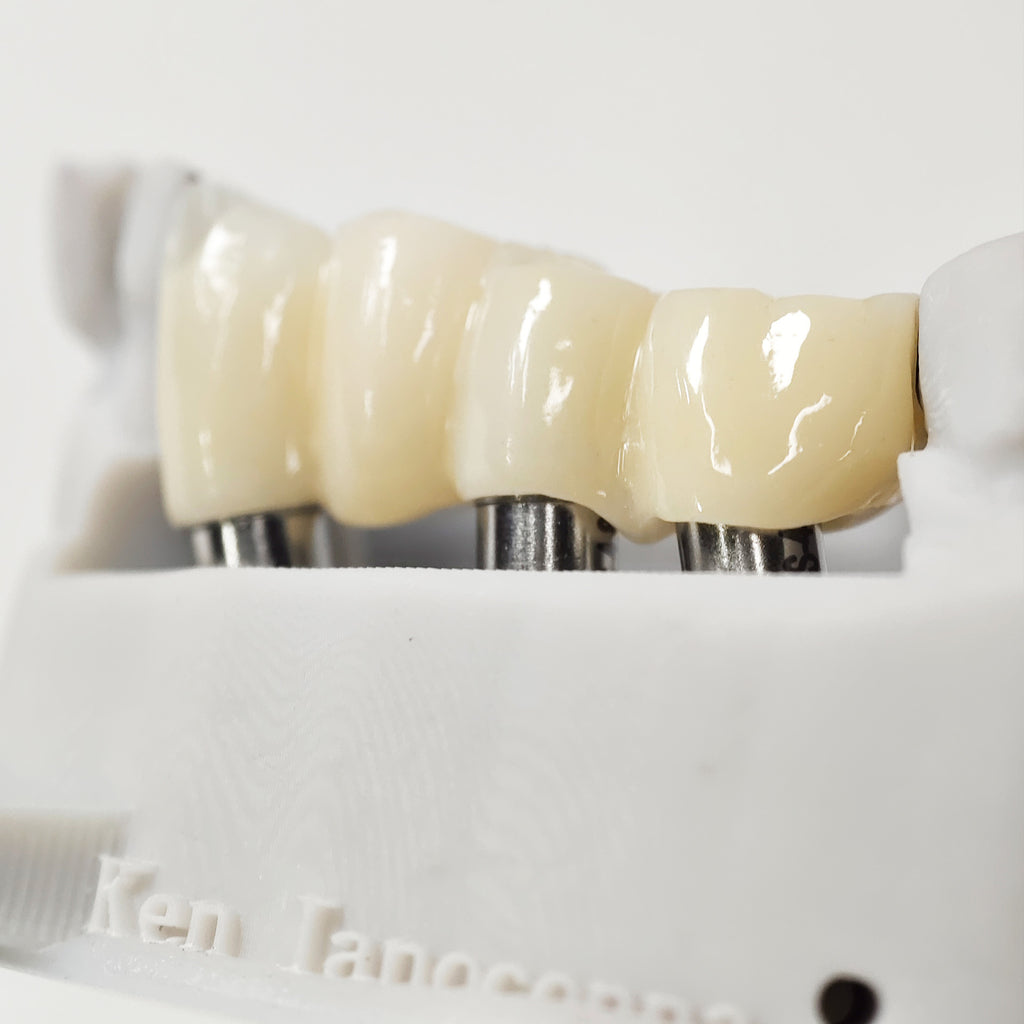 Zirconia Bridge With Ti-Base Screw Retained
