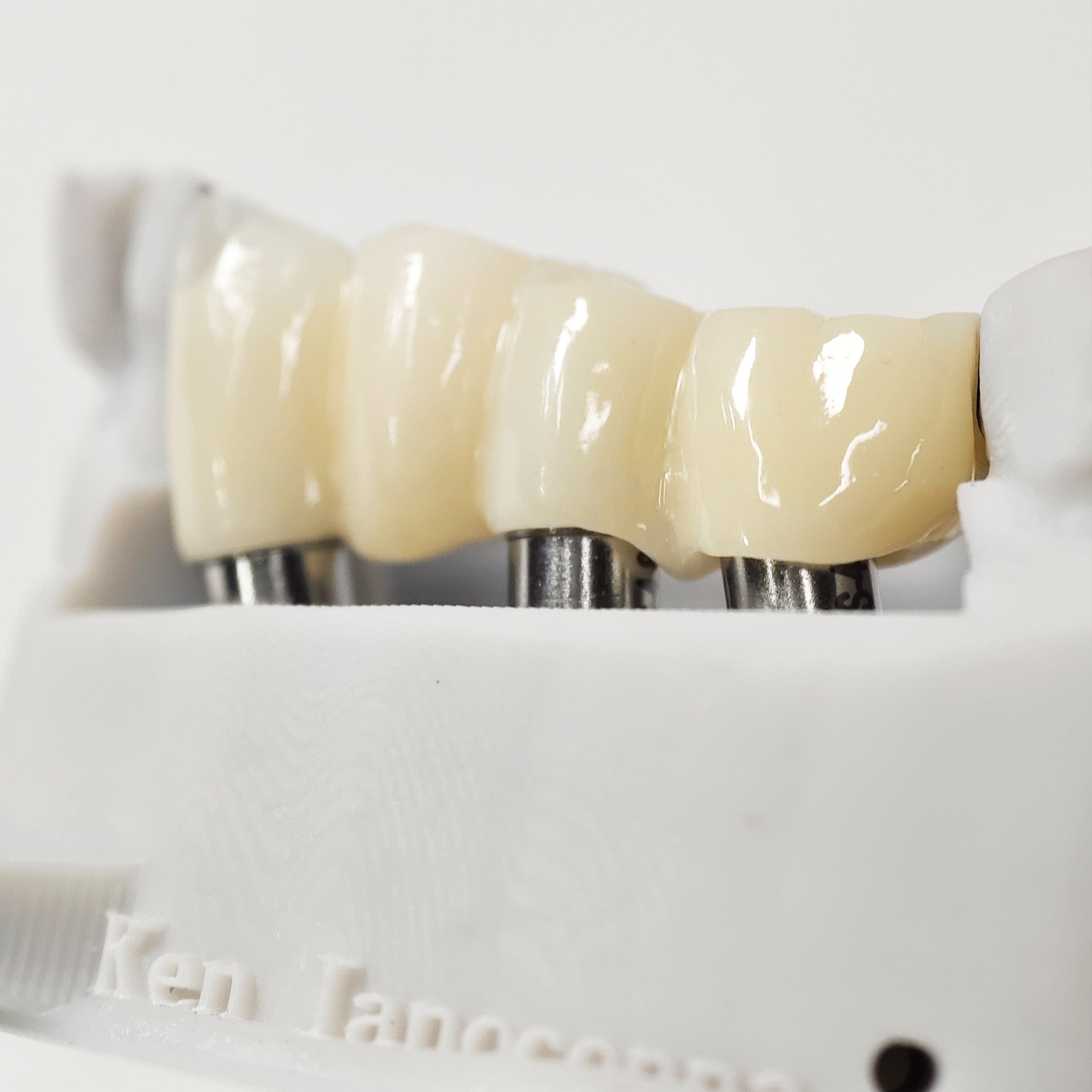 Zirconia Bridge With Ti-Base Screw Retained