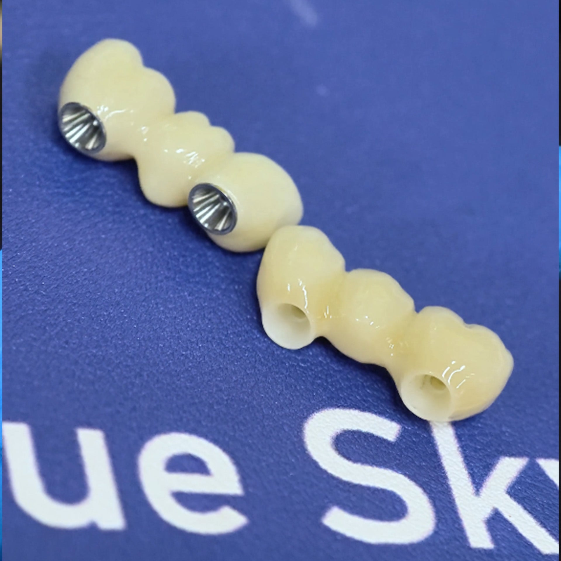 Zirconia Bridge With Ti-Base Screw Retained