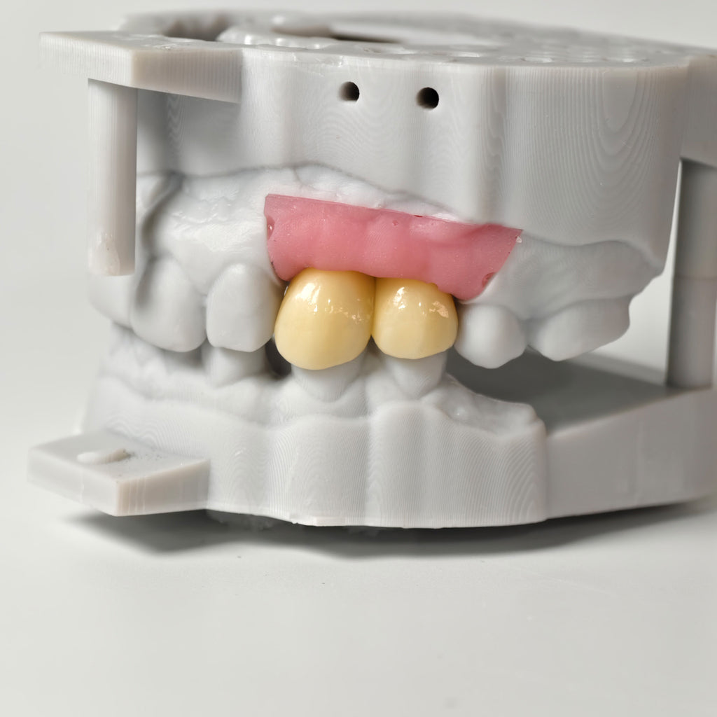 Zirconia Crowns With Gold-Plated Abutment