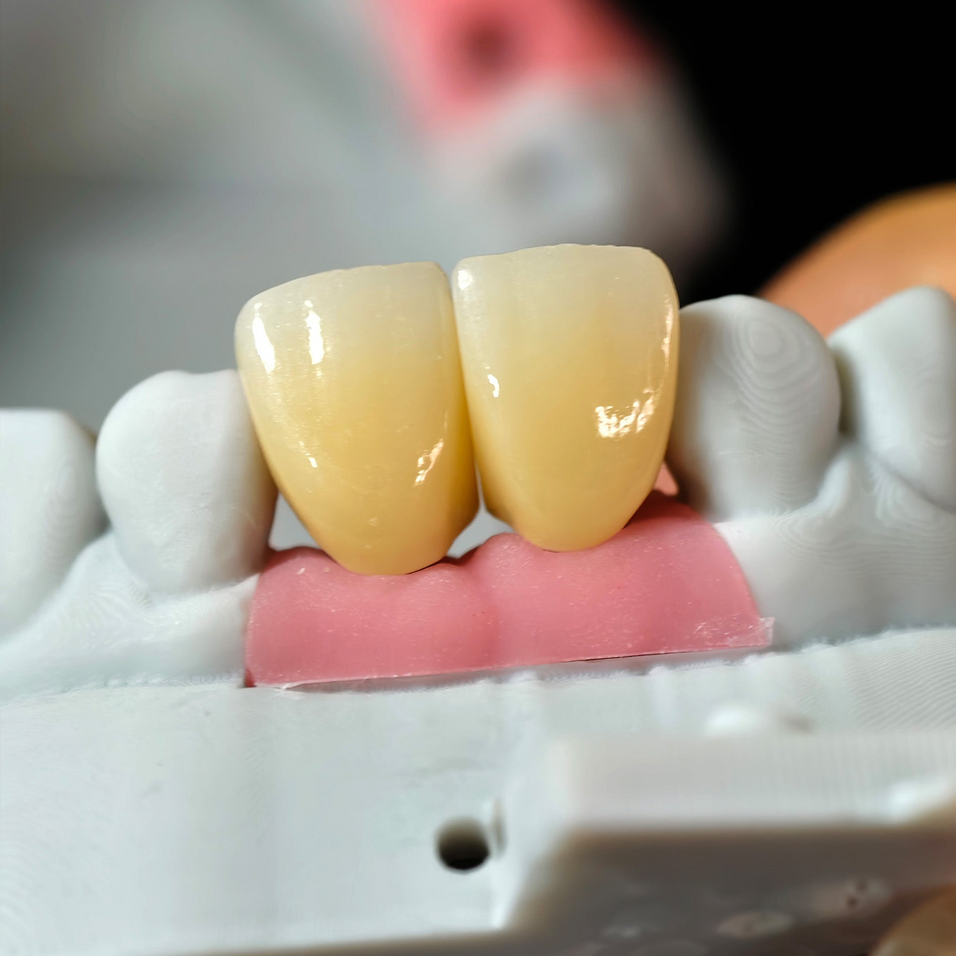 Zirconia Crowns With Gold-Plated Abutment And Implant Seating Guide