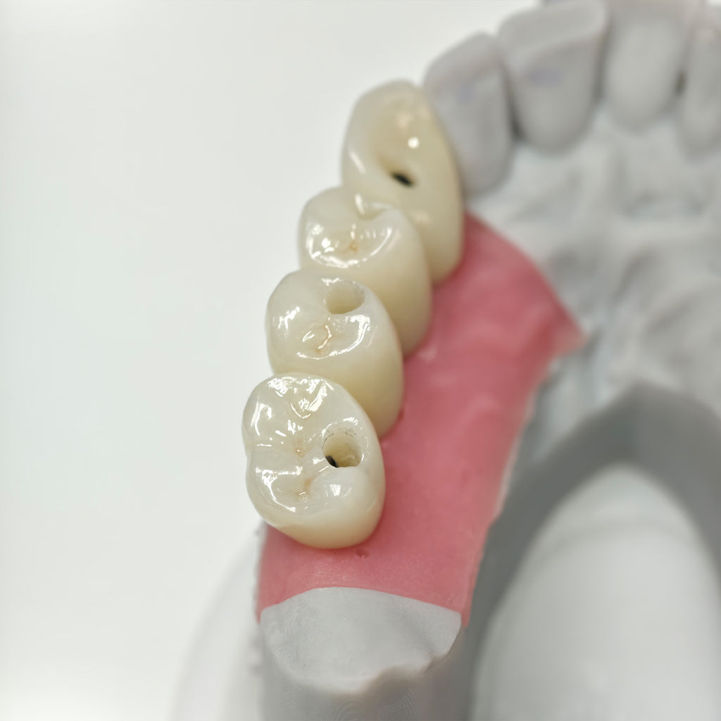 Zirconia Crowns With Screw Retained