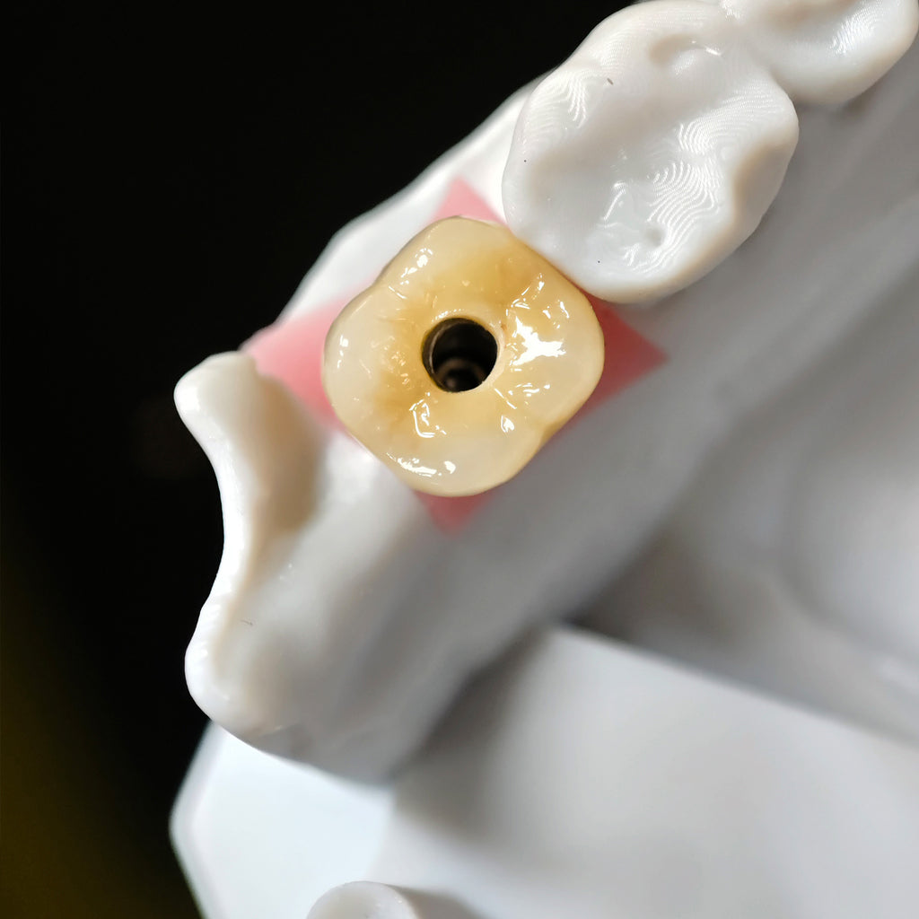 Zirconia Crowns With Screw Retained