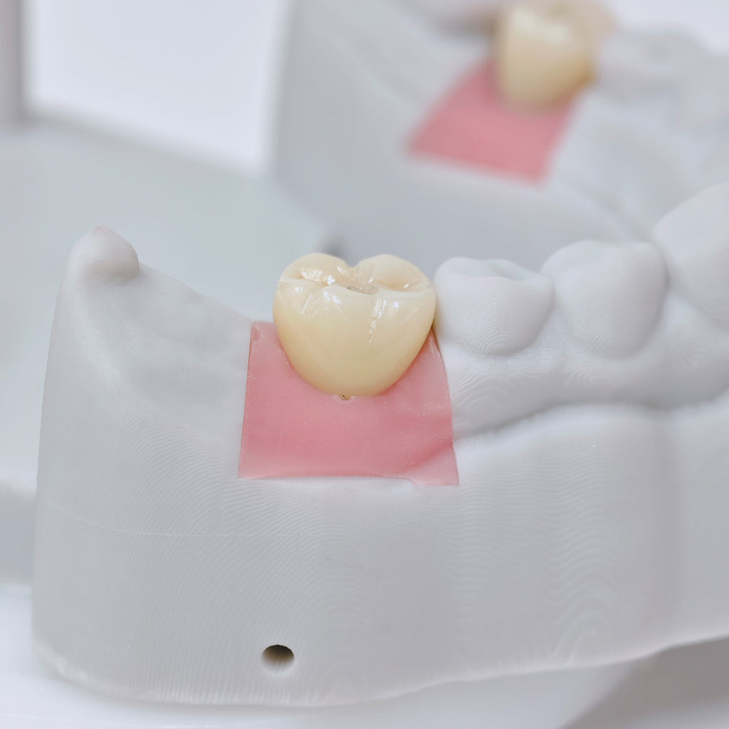 Zirconia Crowns With Screw Retained