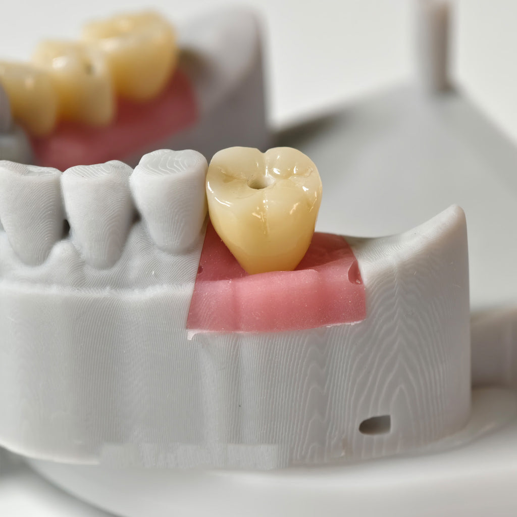 Zirconia Crowns With Screw Retained