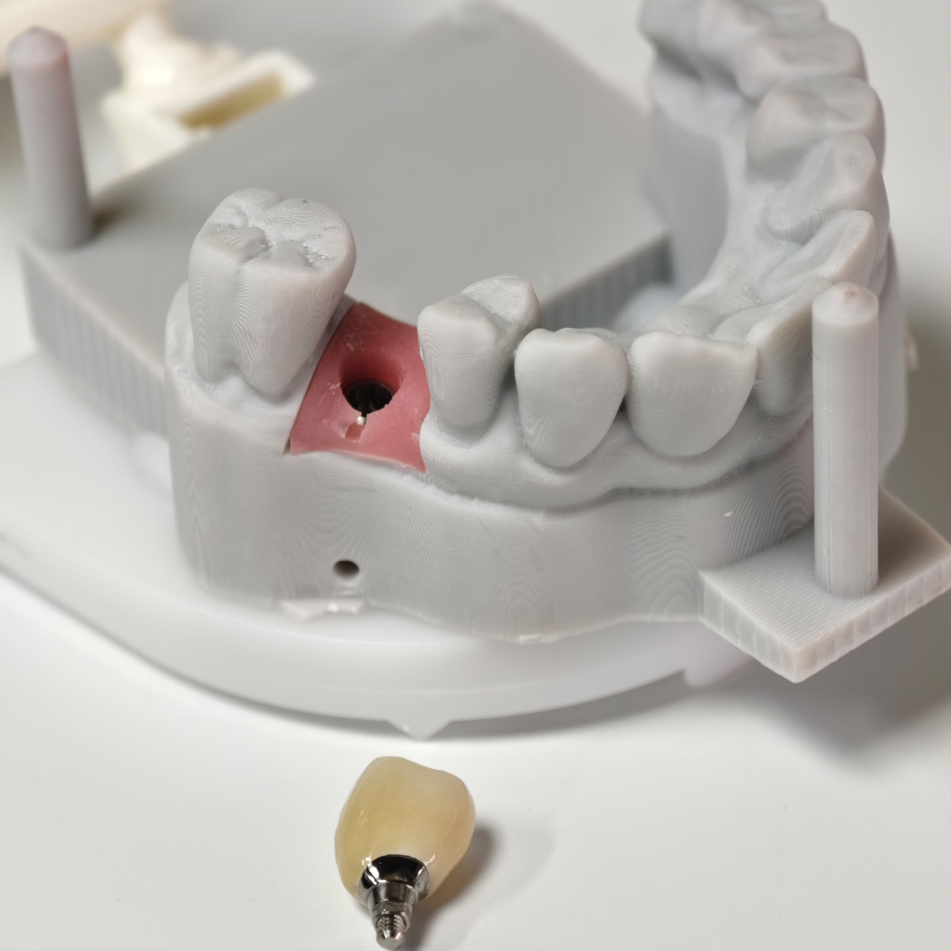 Zirconia Crowns With Screw Retained