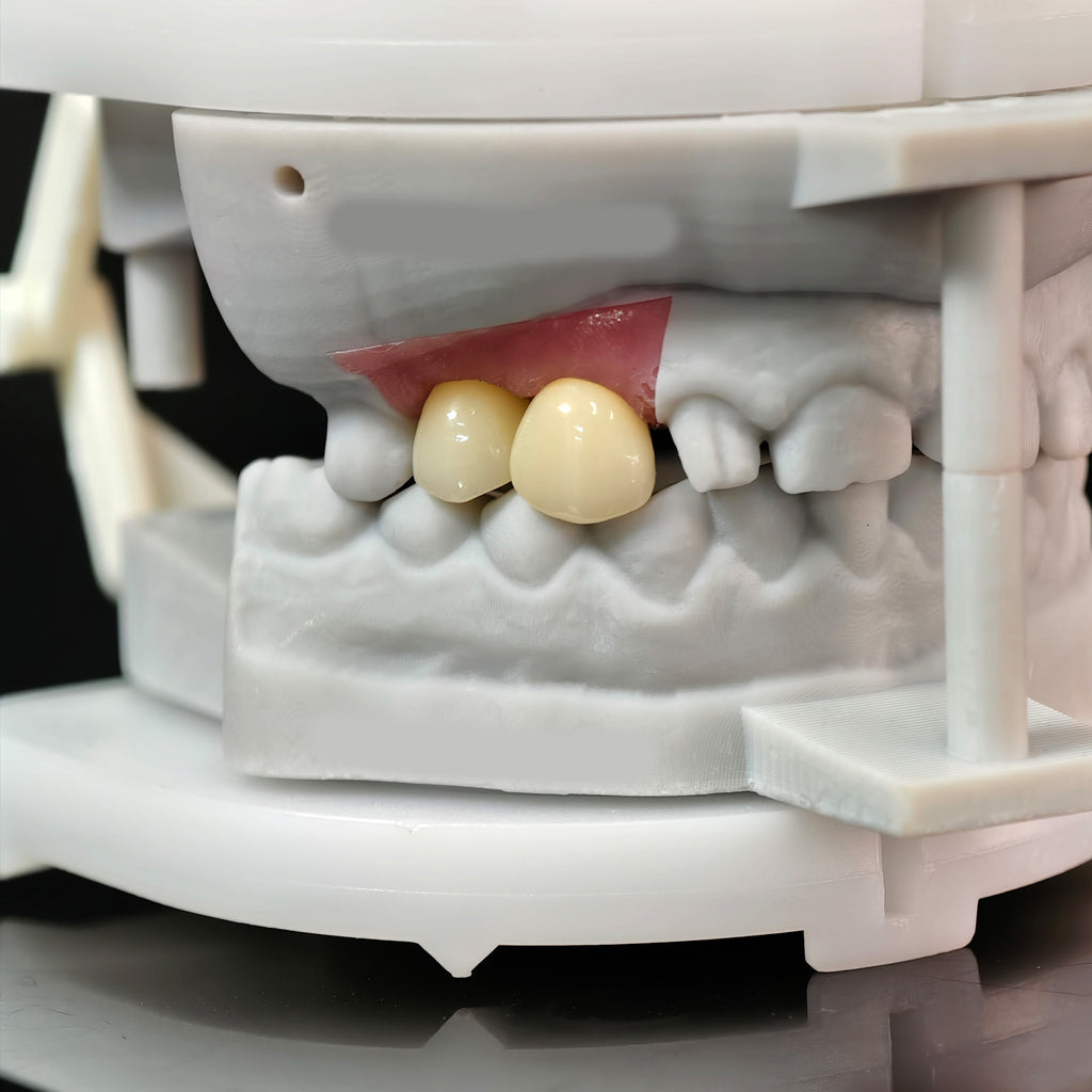 Zirconia Crowns With Screw Retained