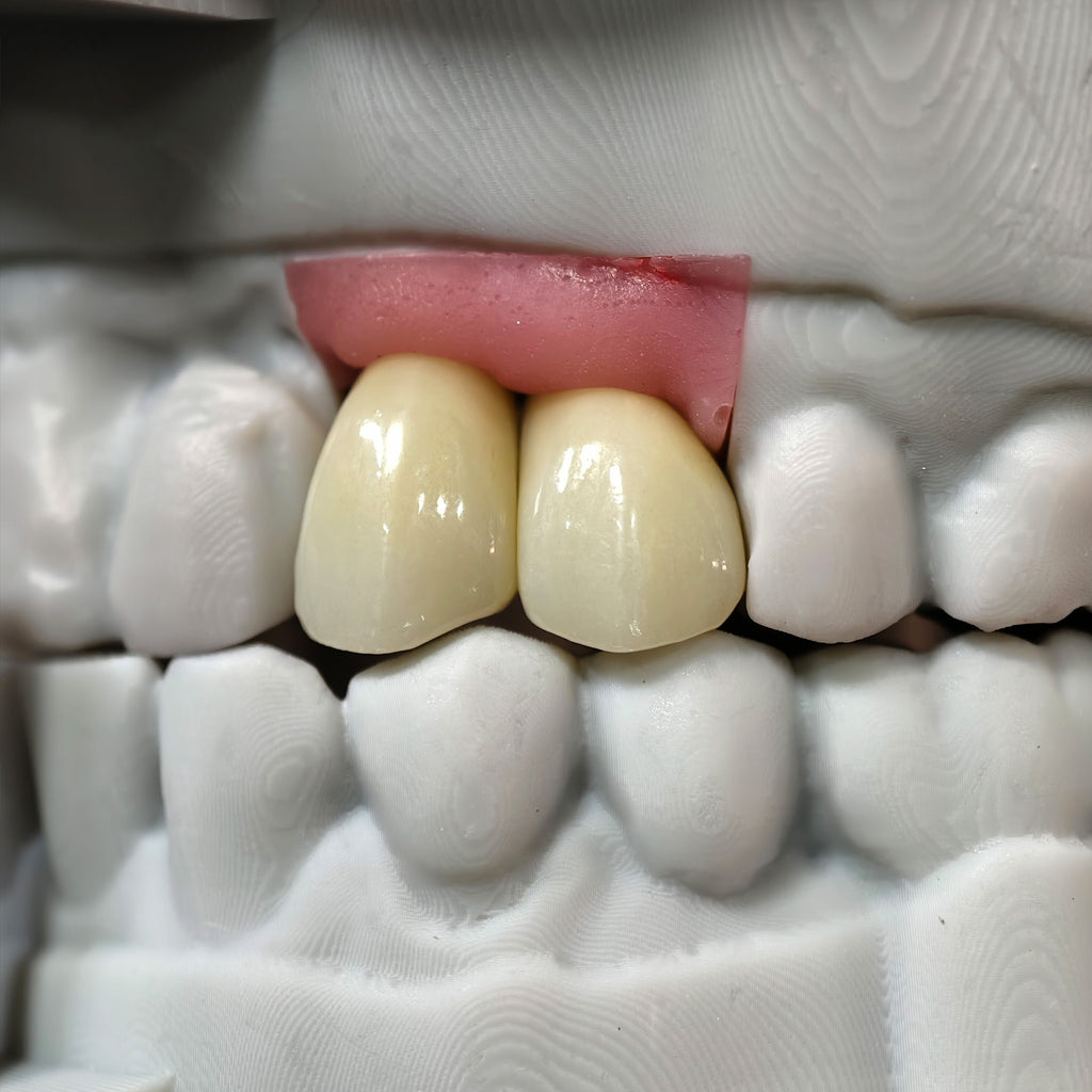 Zirconia Crowns With Screw Retained