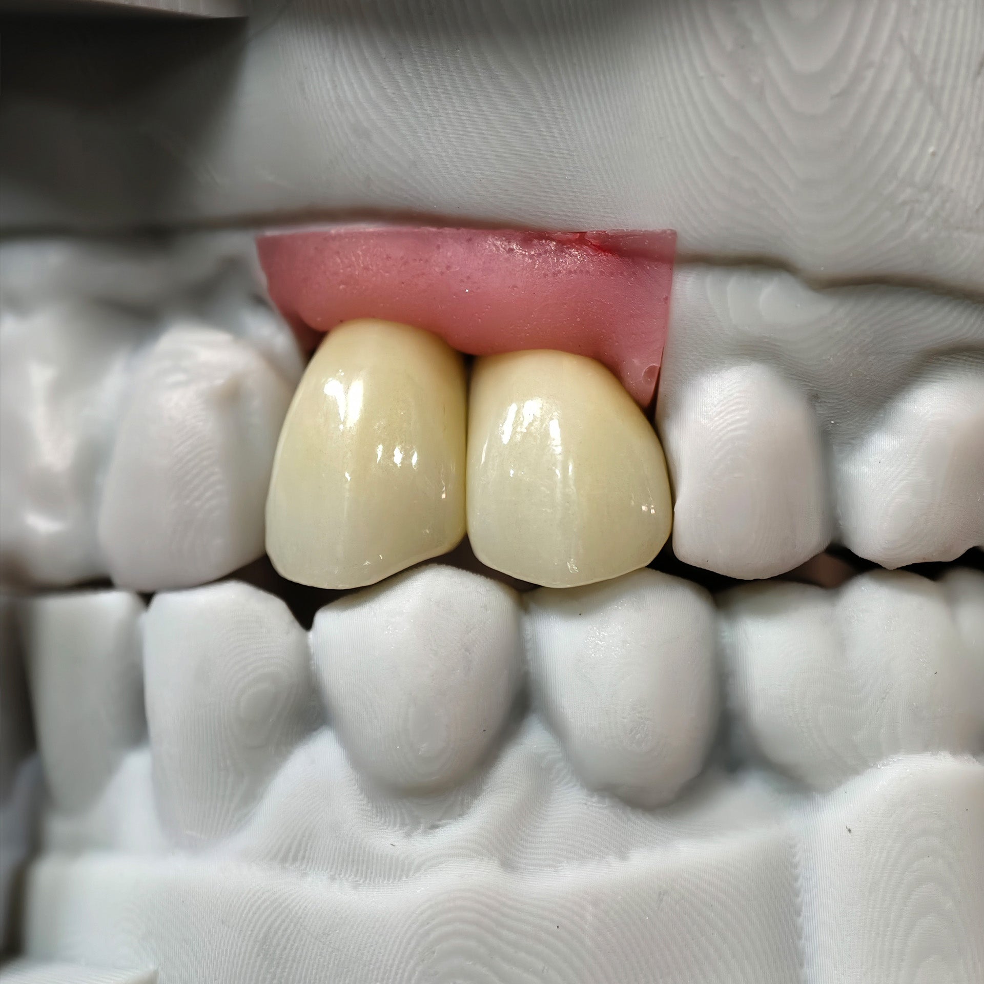Zirconia Crowns With Screw Retained