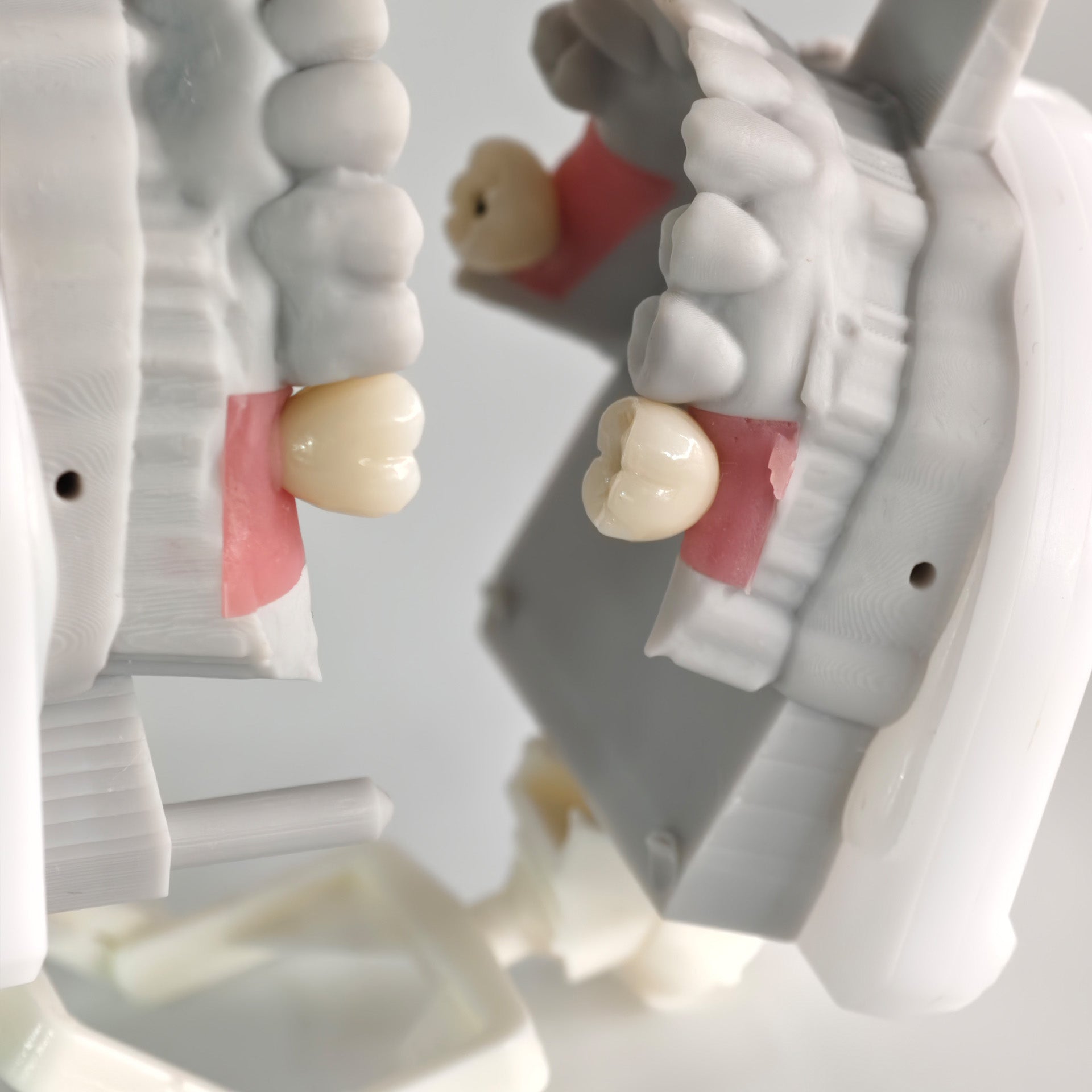 Zirconia Crowns With Screw Retained