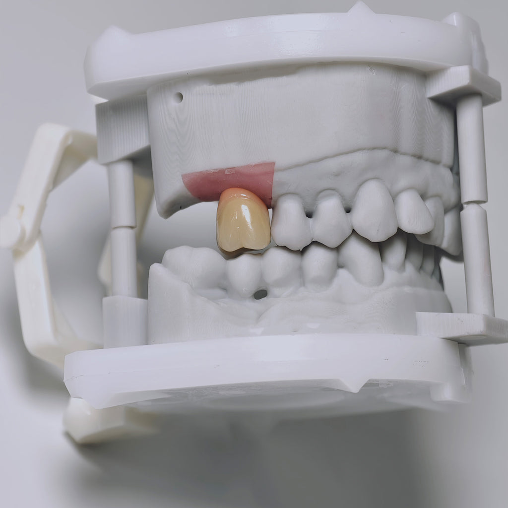 Zirconia Crowns With Screw Retained