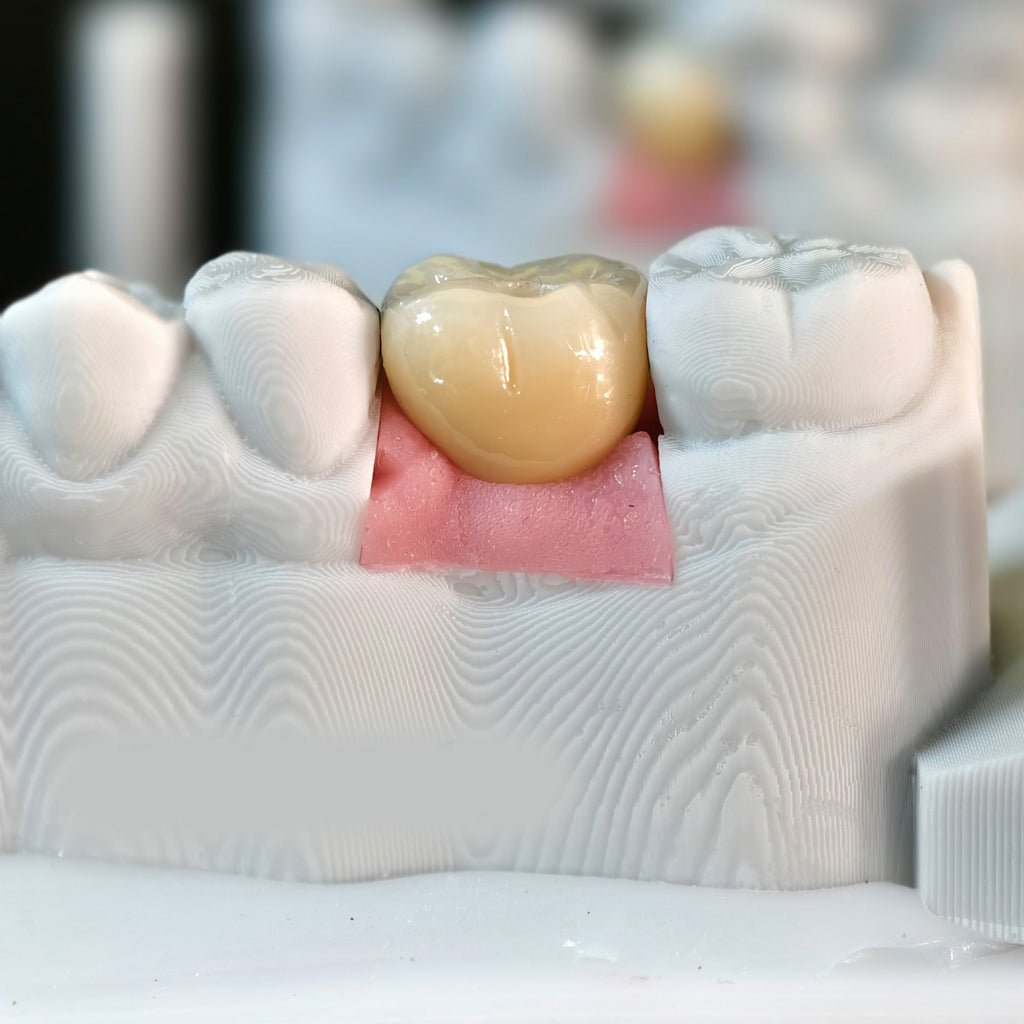 Zirconia Crowns With Screw Retained